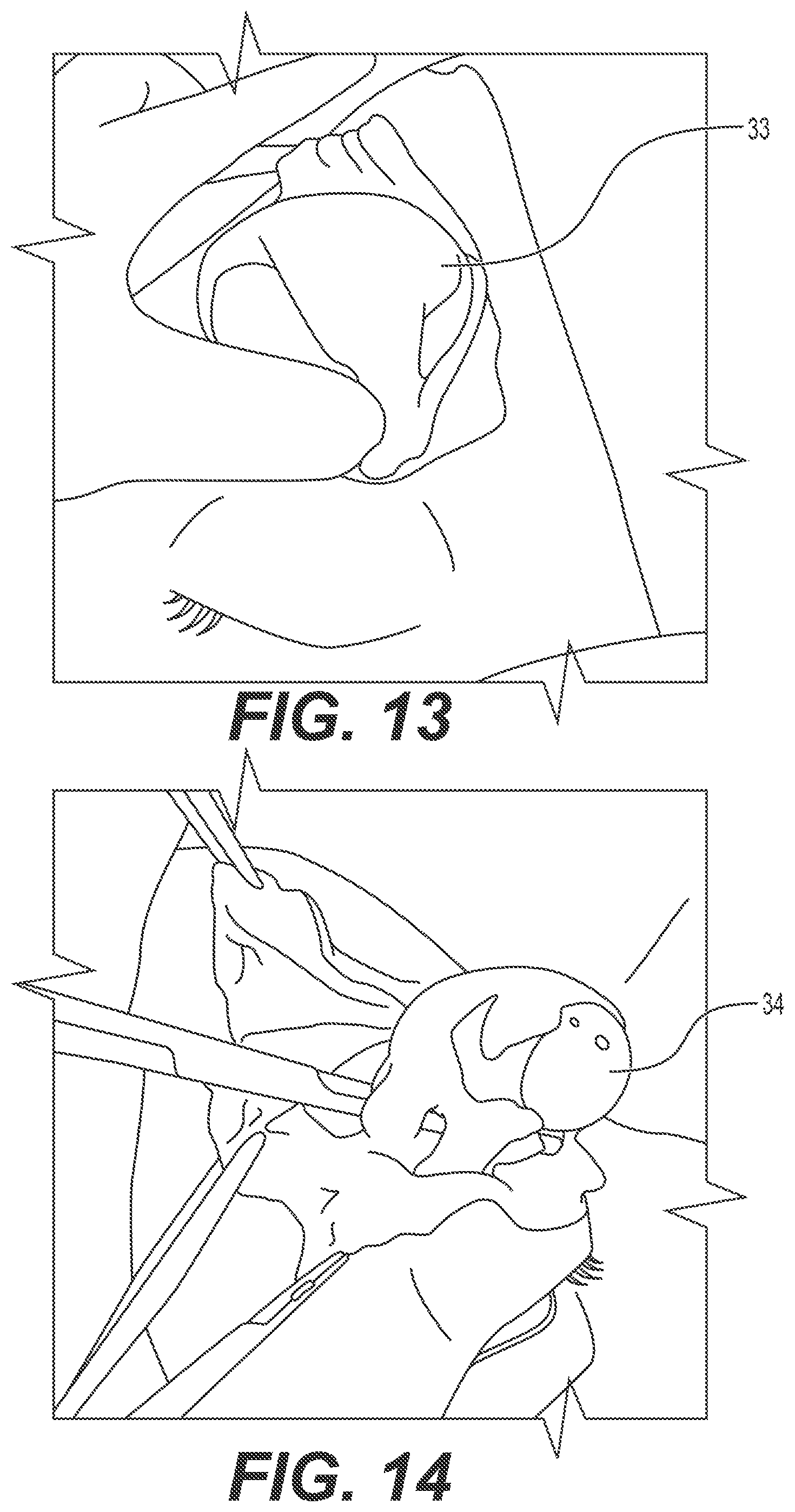 Patent US12167868 Figure 7 – Enucleation-exenteration approach of the camel eye via the supraorbital fossa
