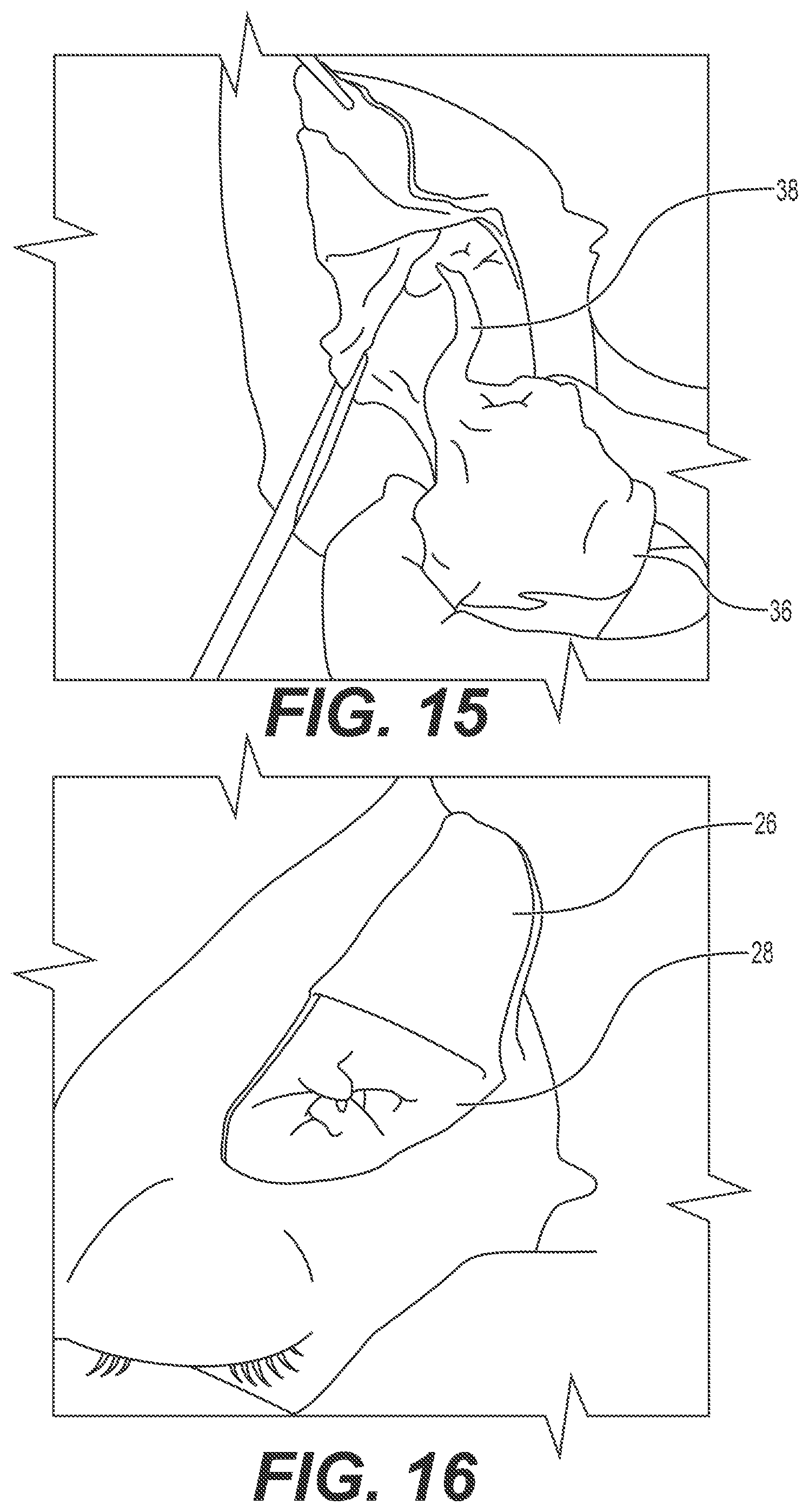 Patent US12167868 Figure 8 – Enucleation-exenteration approach of the camel eye via the supraorbital fossa