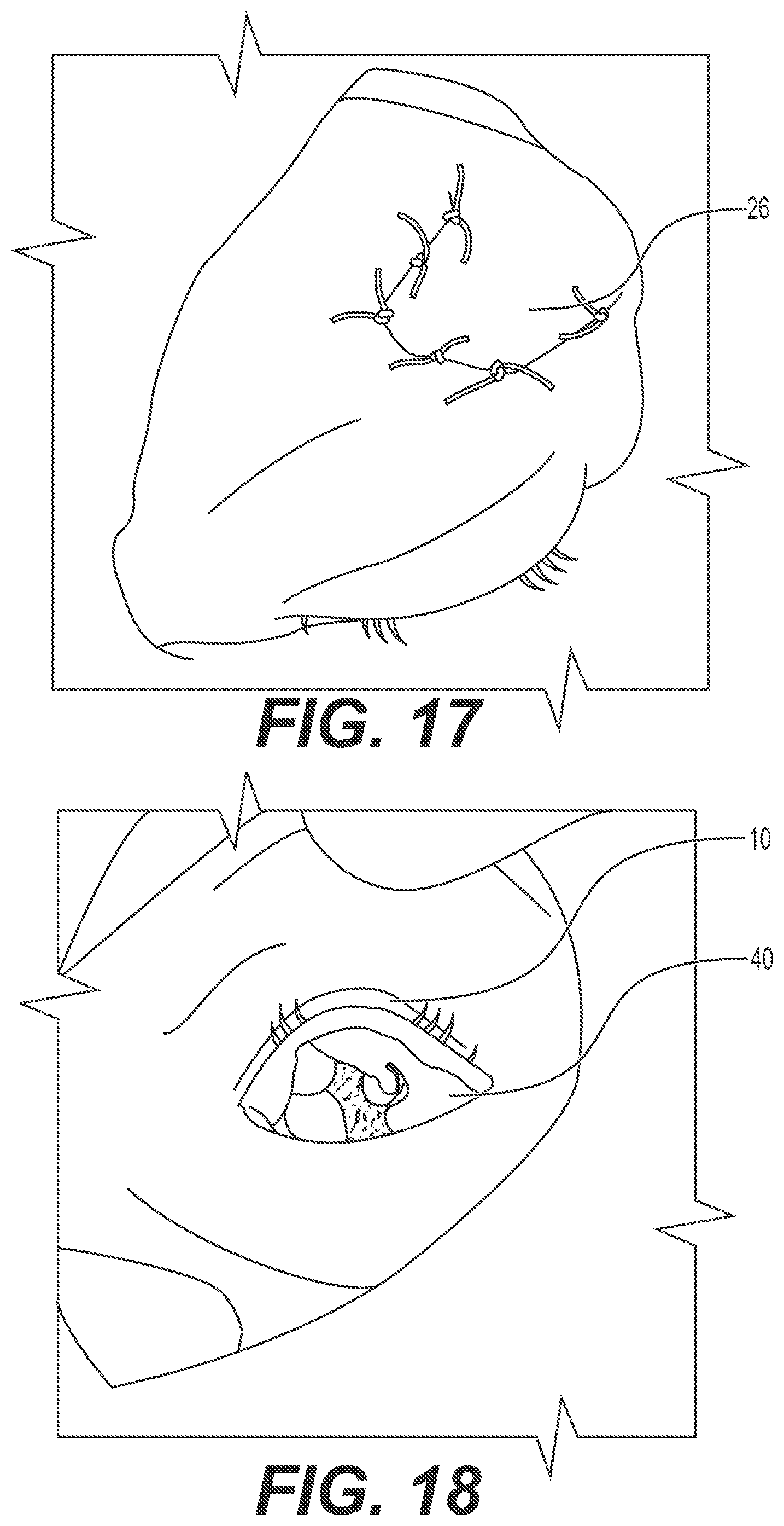 Patent US12167868 Figure 9 – Enucleation-exenteration approach of the camel eye via the supraorbital fossa