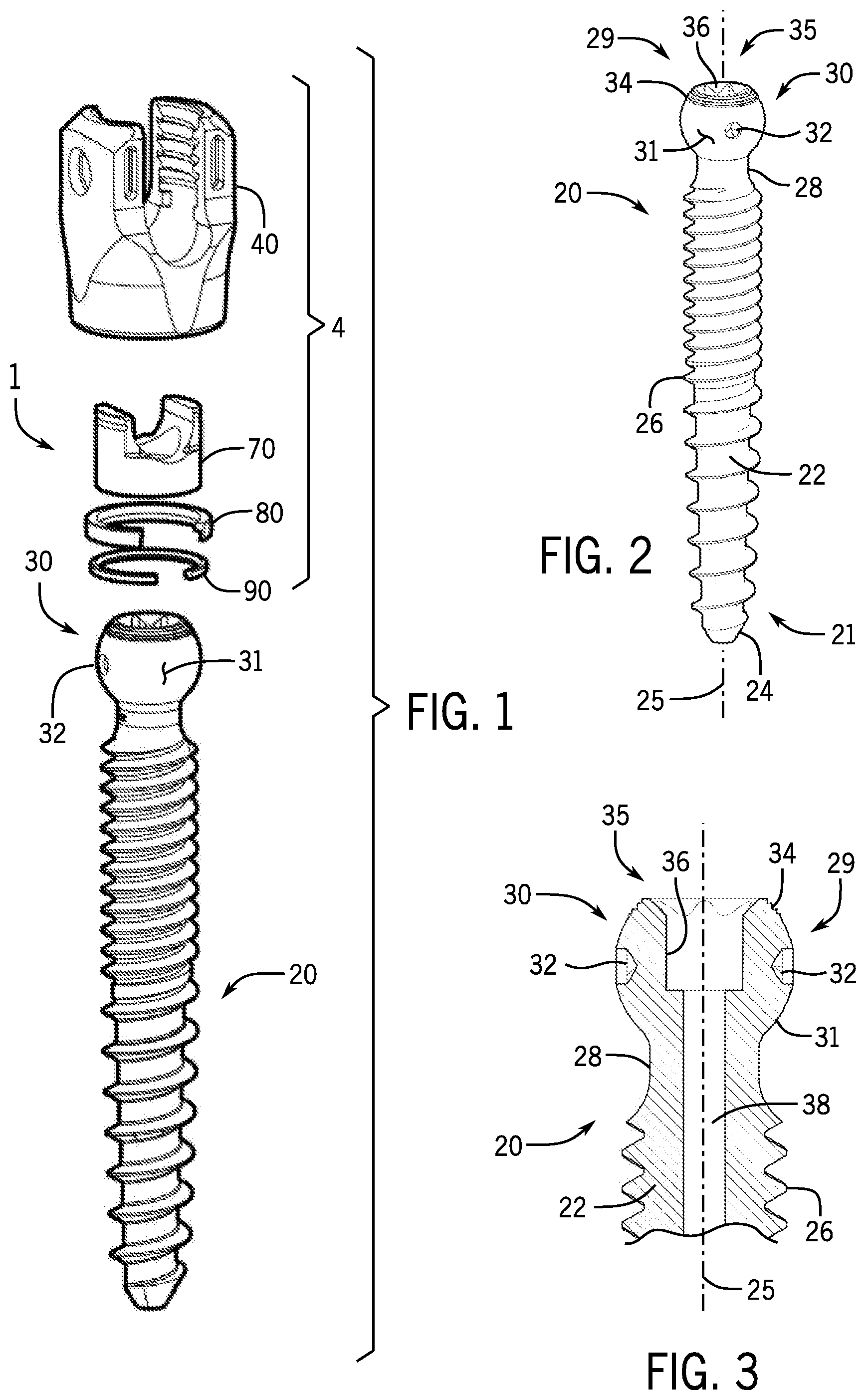 Patent US12167872 Figure 1 – Bottom loaded pivotal bone anchor assembly with locking and blocking rings and insert tool deployment