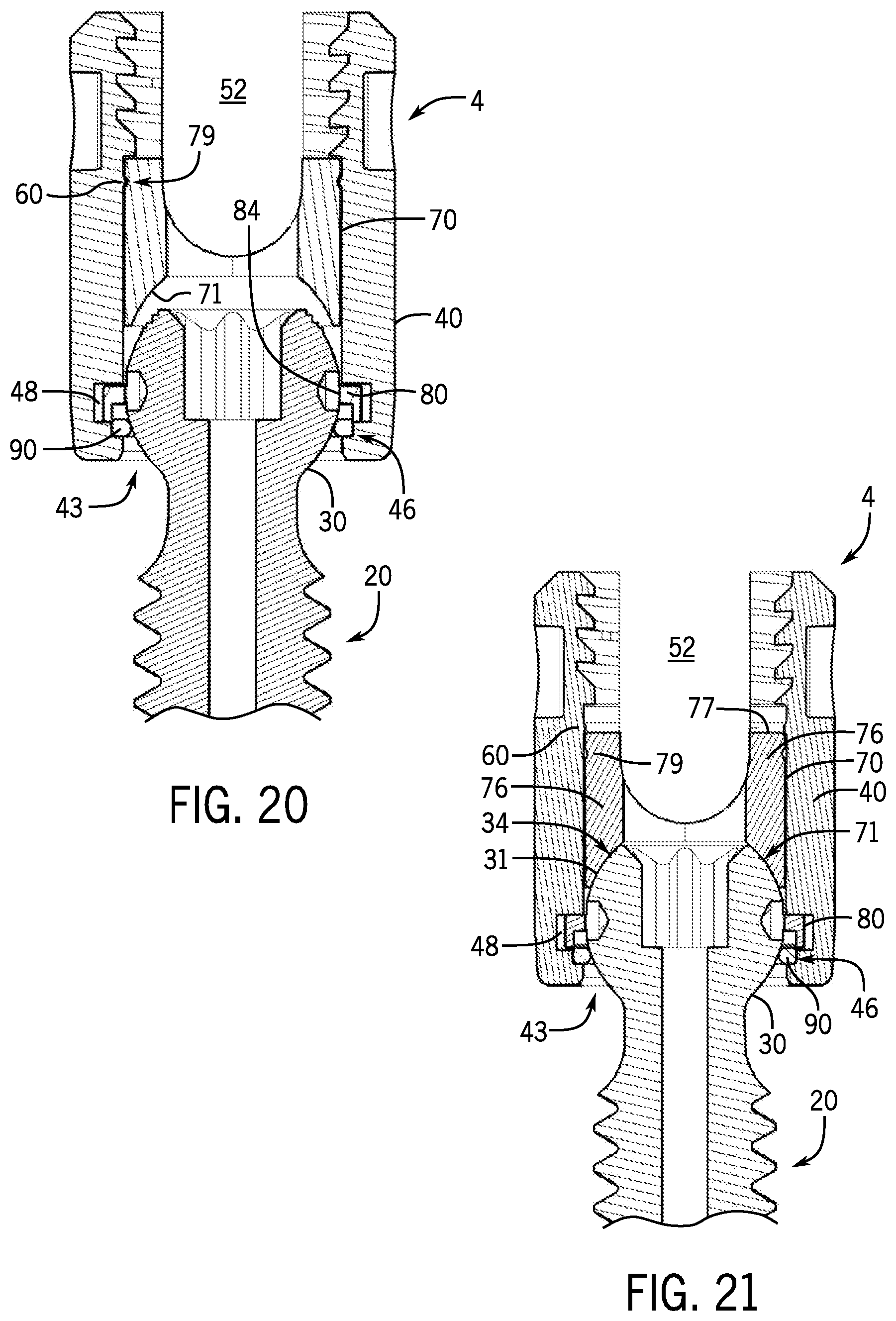Patent US12167872 Figure 8 – Bottom loaded pivotal bone anchor assembly with locking and blocking rings and insert tool deployment