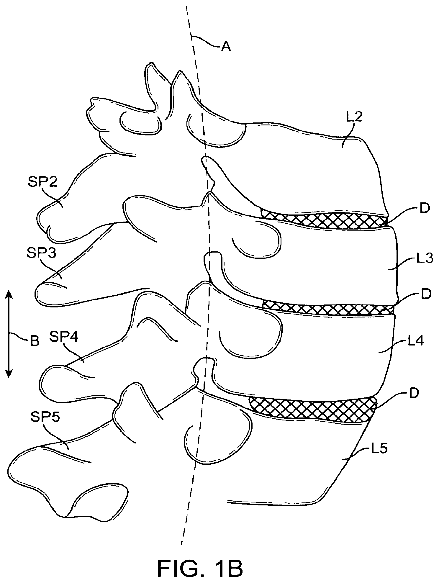 Patent US12167874 Figure 2 – Surgical tether apparatus and methods of use