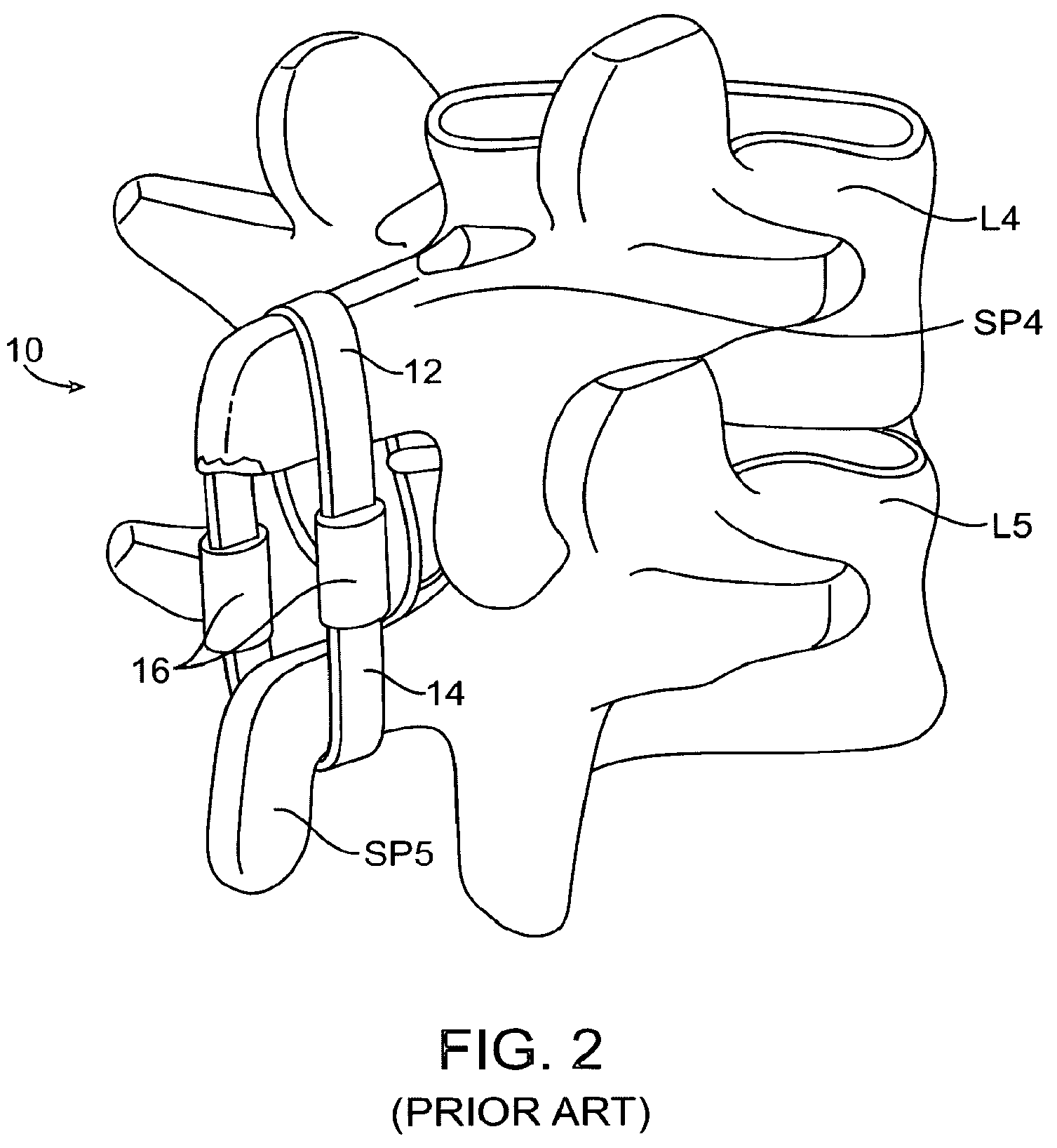 Patent US12167874 Figure 3 – Surgical tether apparatus and methods of use