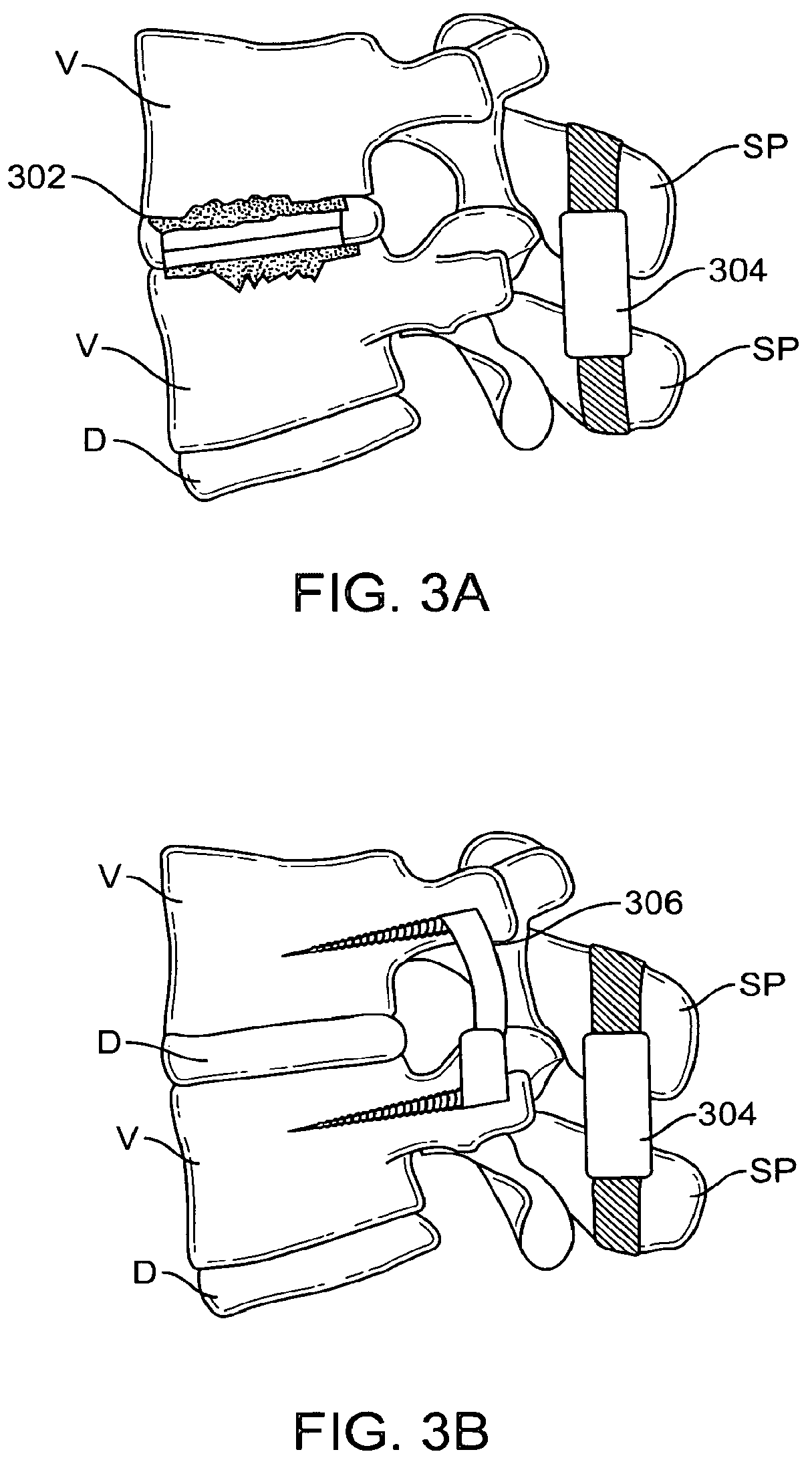 Patent US12167874 Figure 4 – Surgical tether apparatus and methods of use