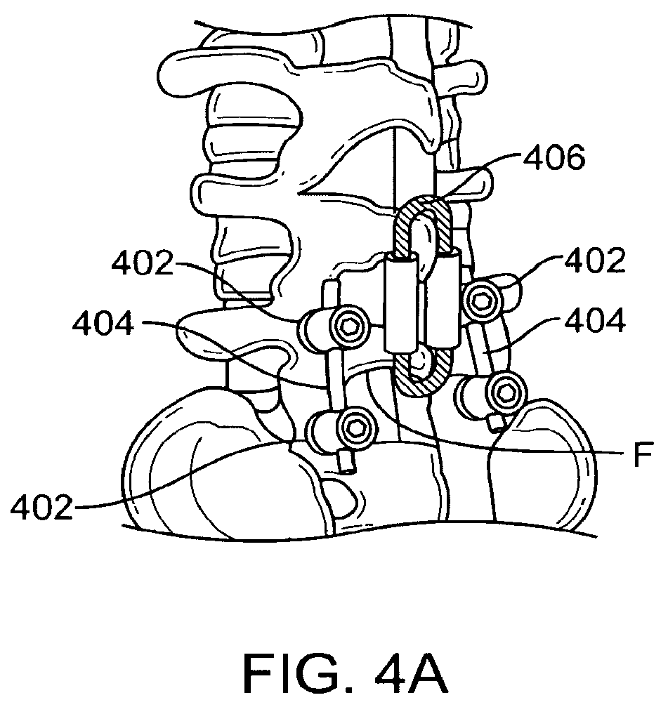 Patent US12167874 Figure 5 – Surgical tether apparatus and methods of use