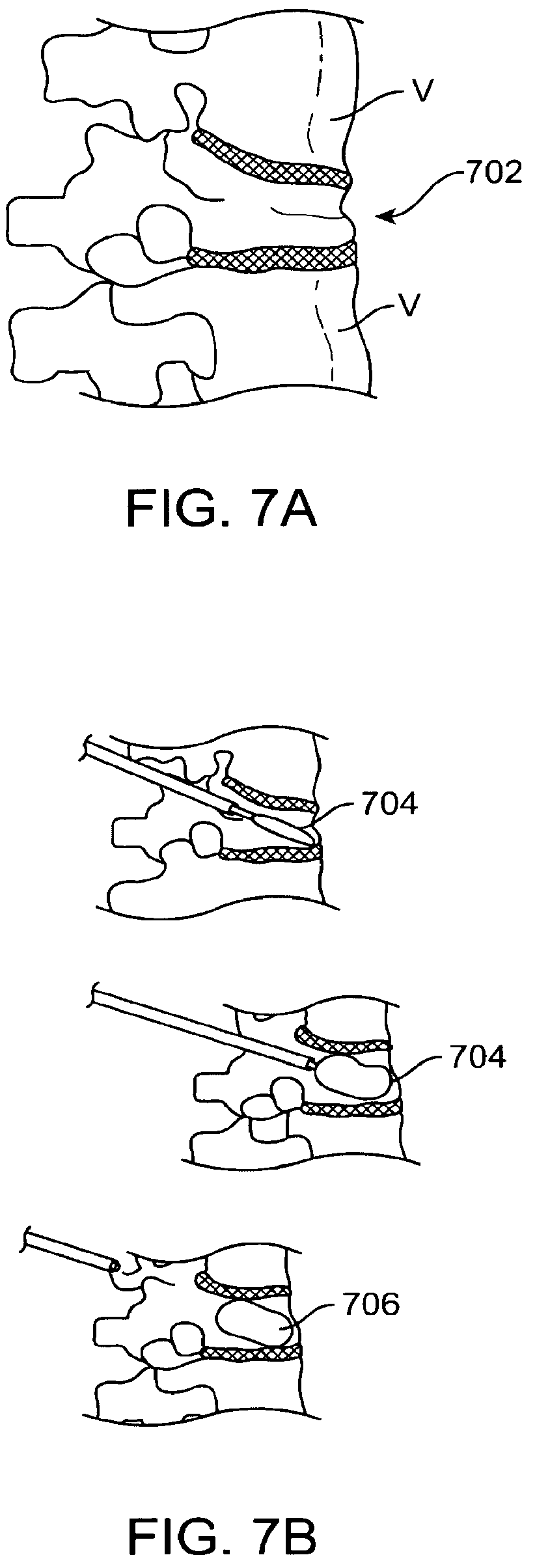 Patent US12167874 Figure 9 – Surgical tether apparatus and methods of use
