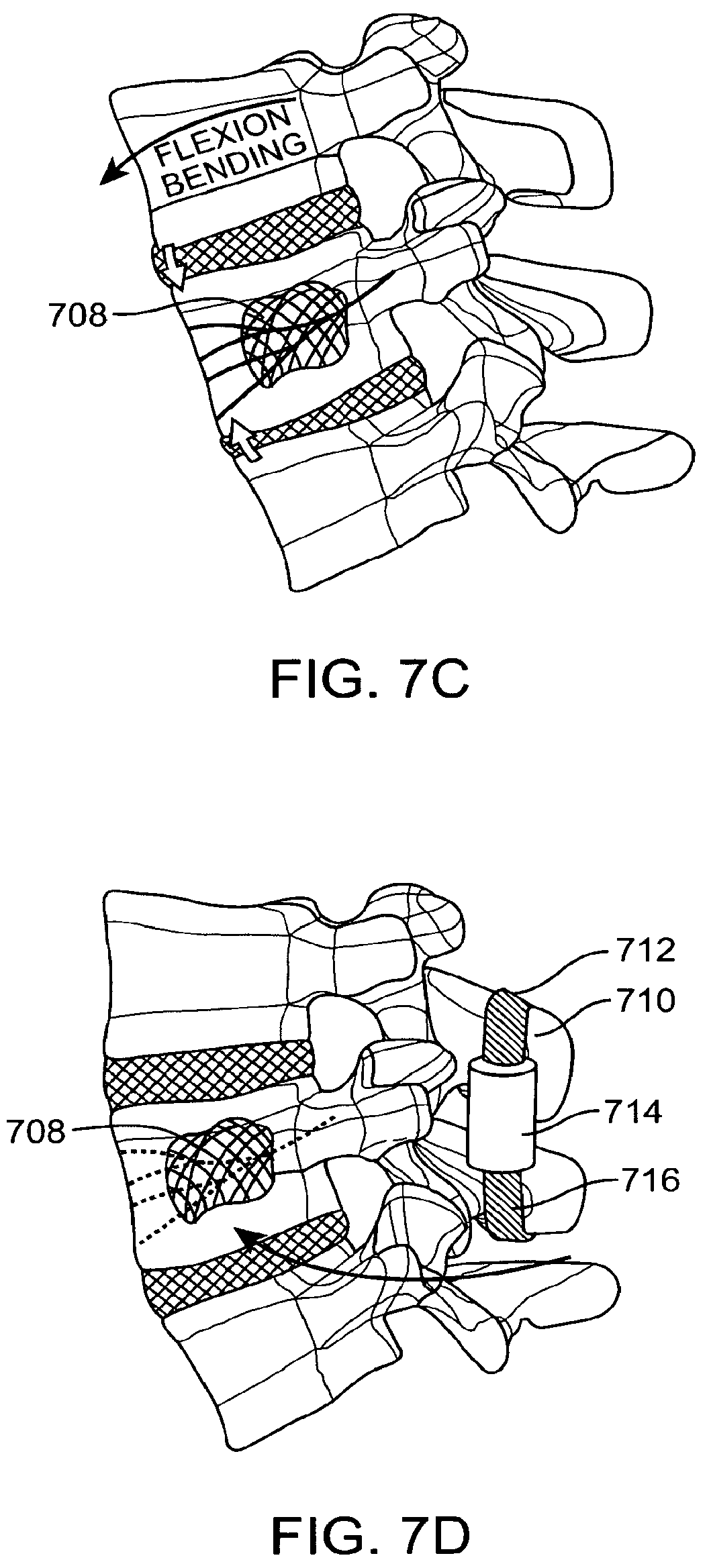 Patent US12167874 Figure 10 – Surgical tether apparatus and methods of use