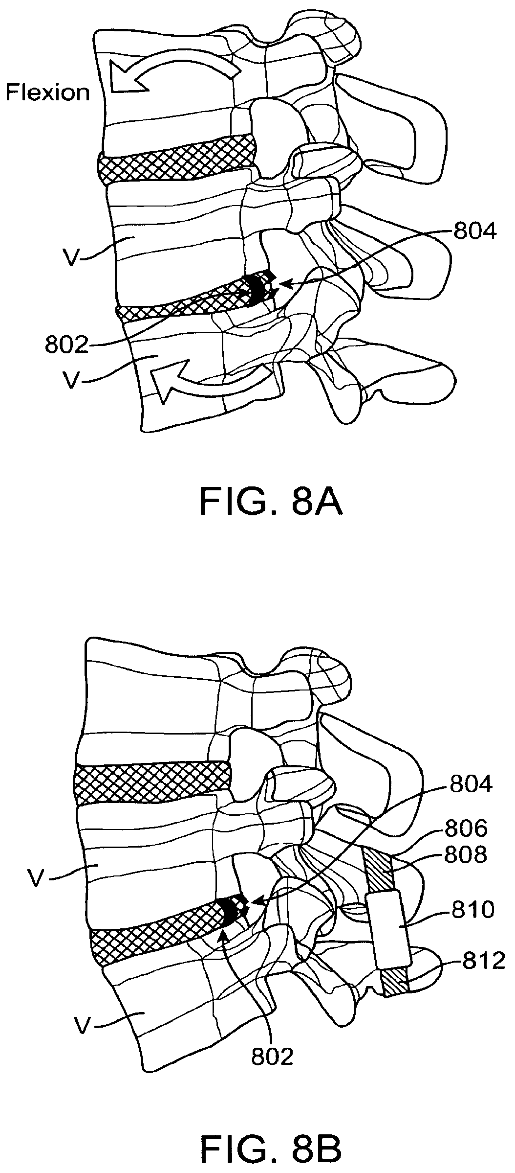 Patent US12167874 Figure 11 – Surgical tether apparatus and methods of use