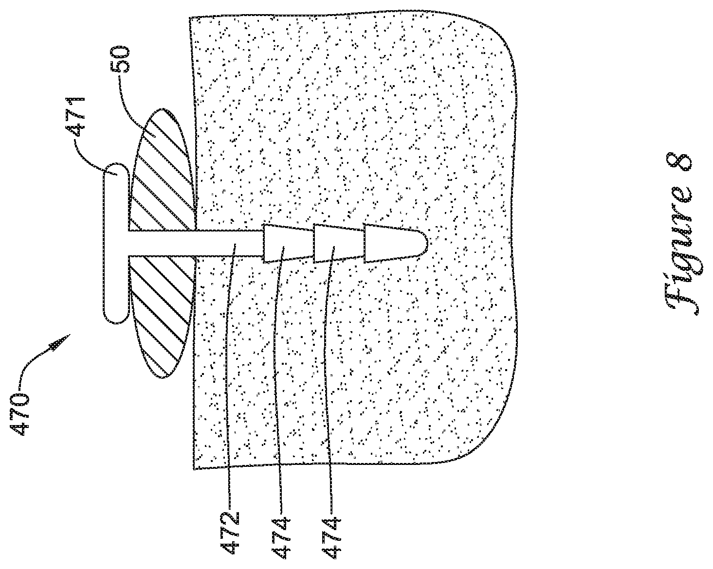 Patent US12167875 Figure 12 – Spinal stabilization installation instrumentation and methods