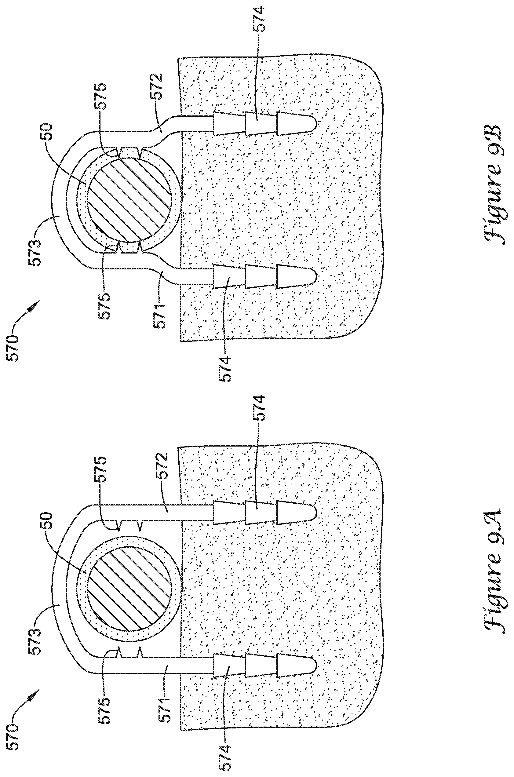 Patent US12167875 Figure 13 – Spinal stabilization installation instrumentation and methods