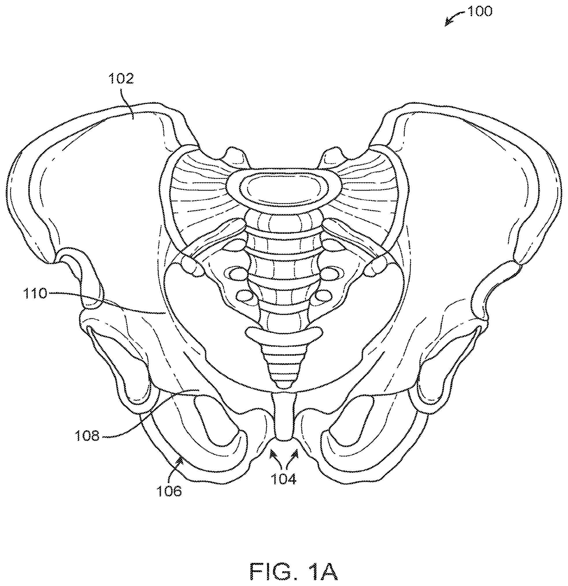 Patent US12167877 Figure 1 – Shape adaptable intramedullary fixation device
