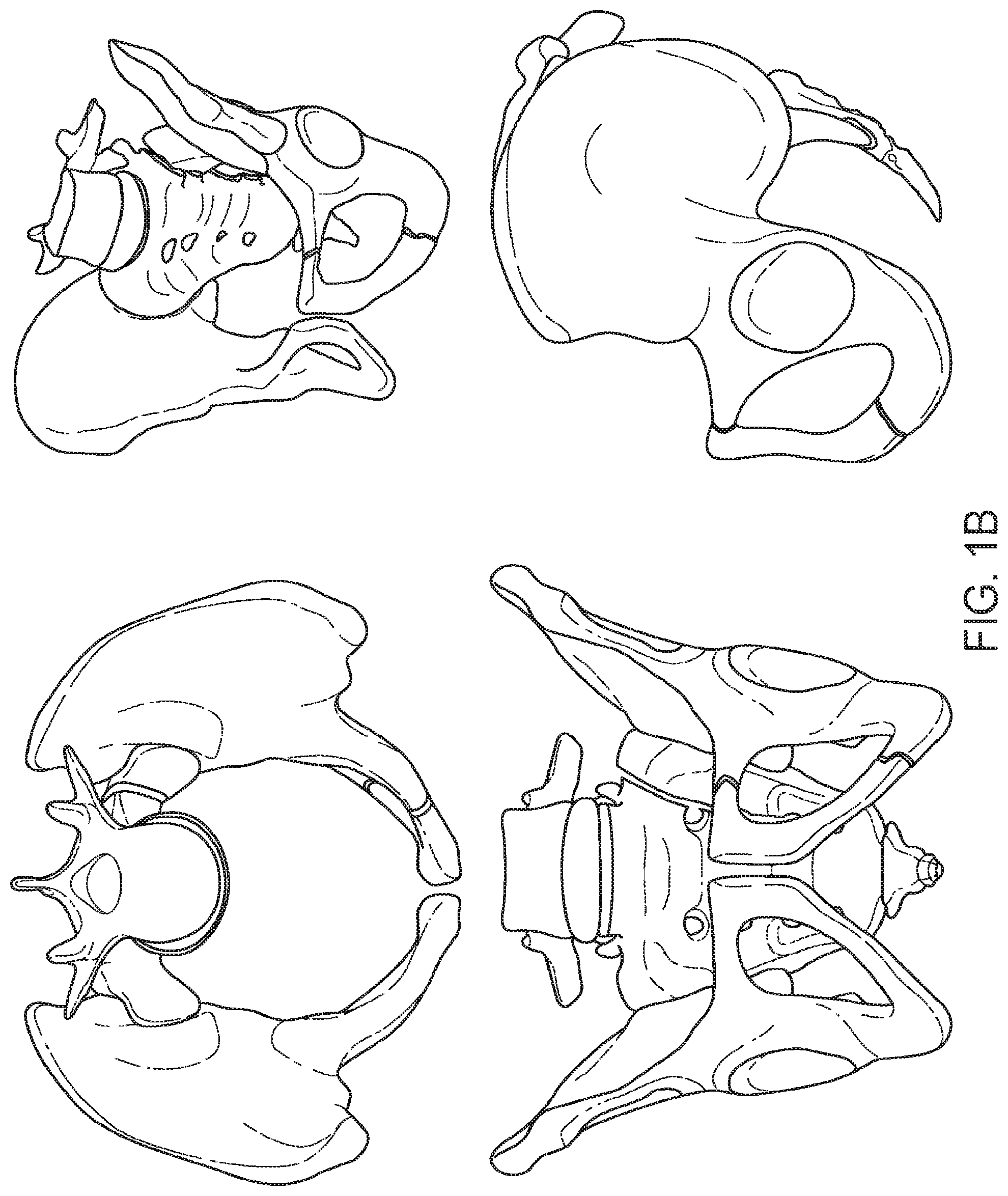 Patent US12167877 Figure 2 – Shape adaptable intramedullary fixation device