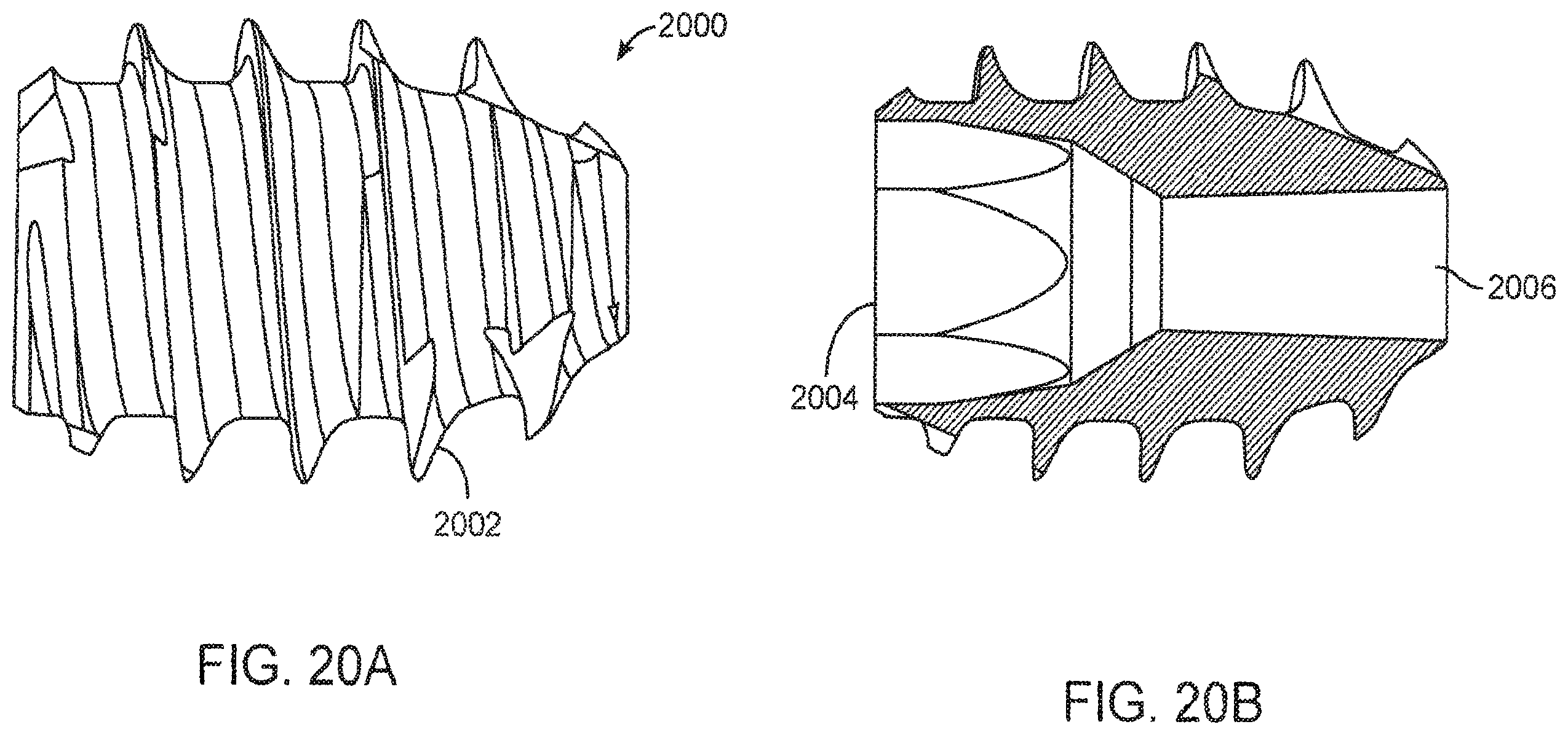 Patent US12167877 Figure 20 – Shape adaptable intramedullary fixation device