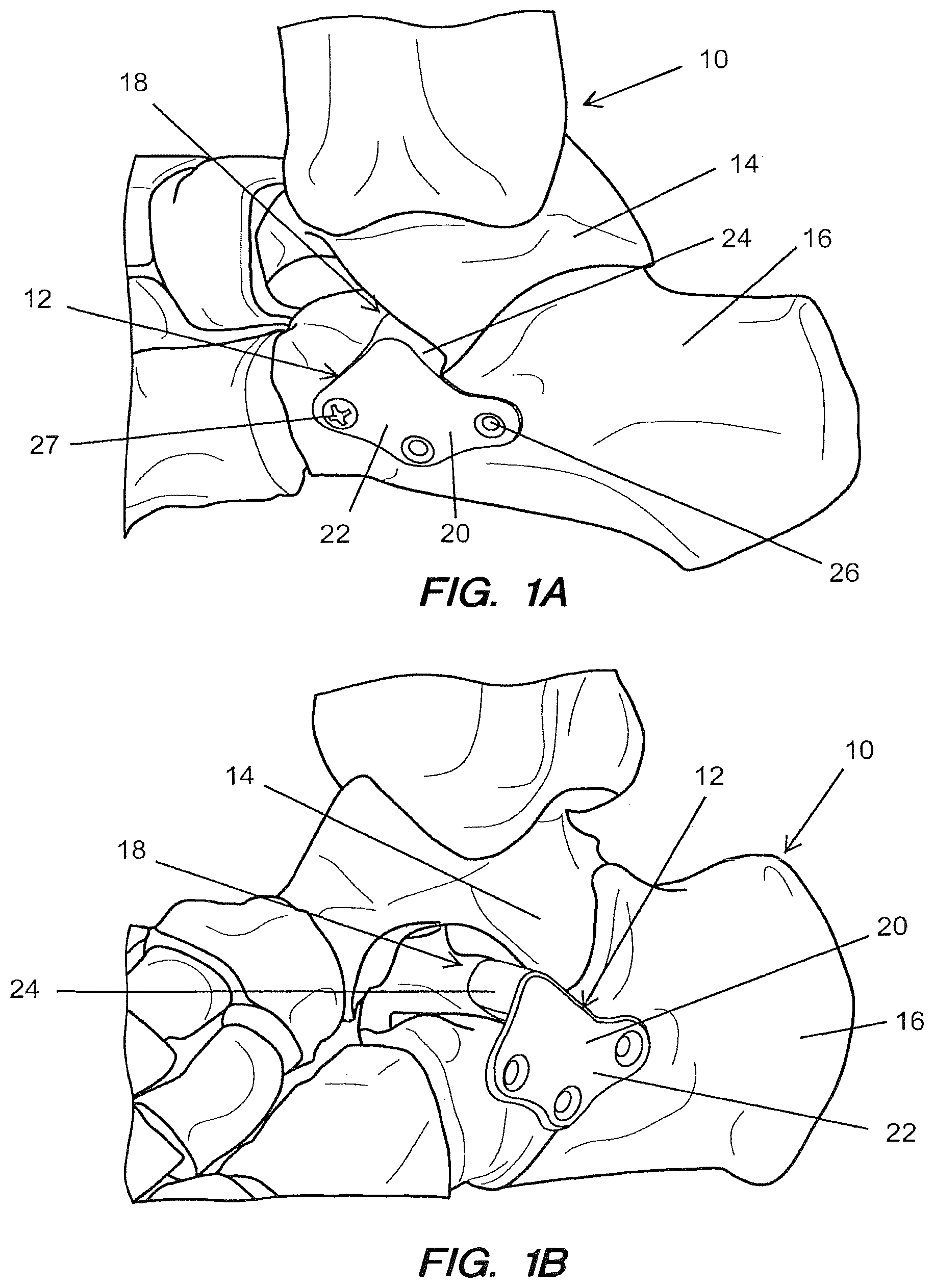 Patent US12167878 Figure 1 – Subtalar plate implant