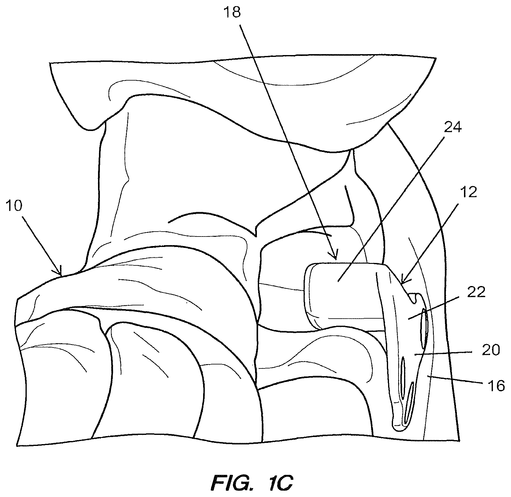 Patent US12167878 Figure 2 – Subtalar plate implant
