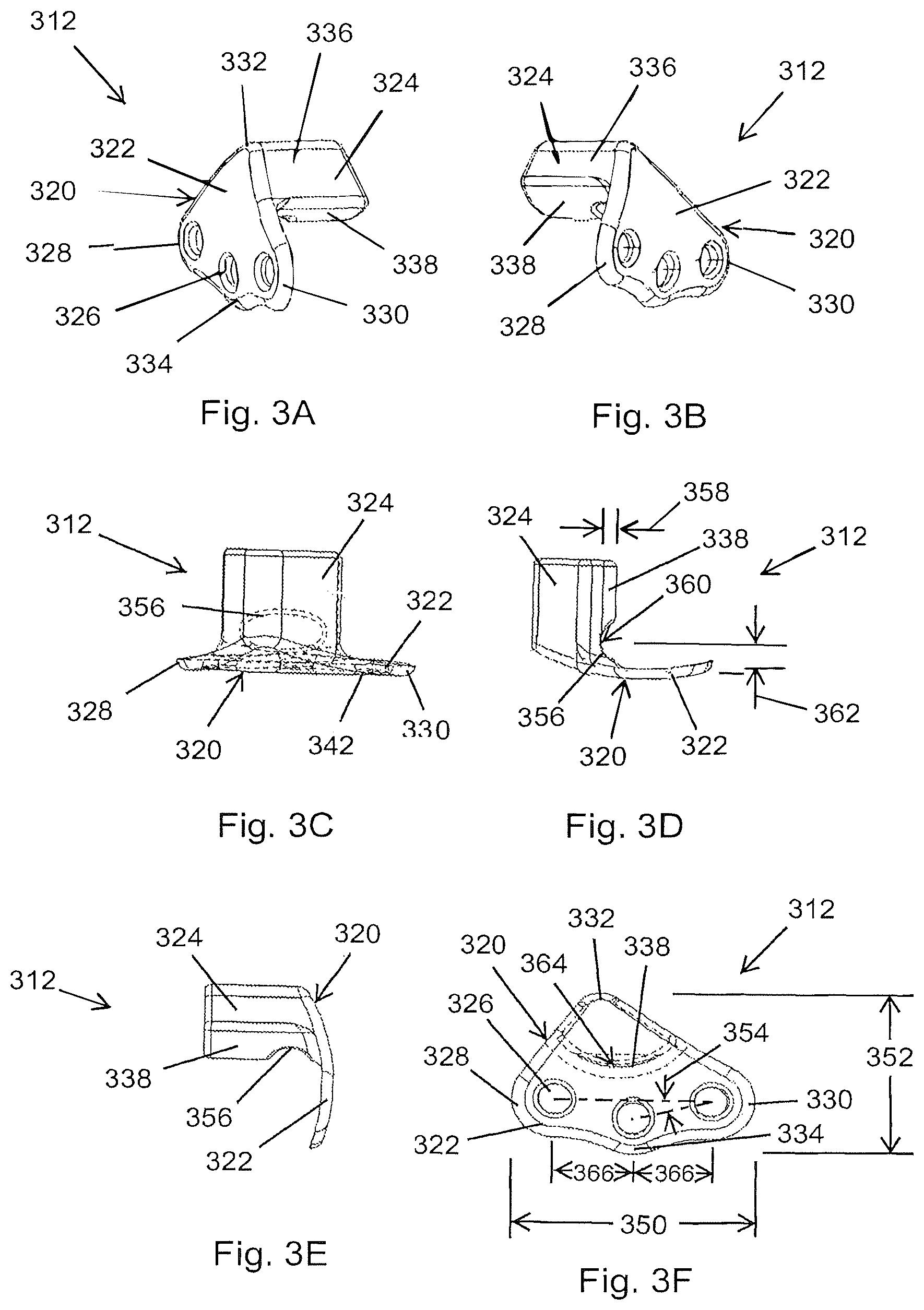 Patent US12167878 Figure 5 – Subtalar plate implant