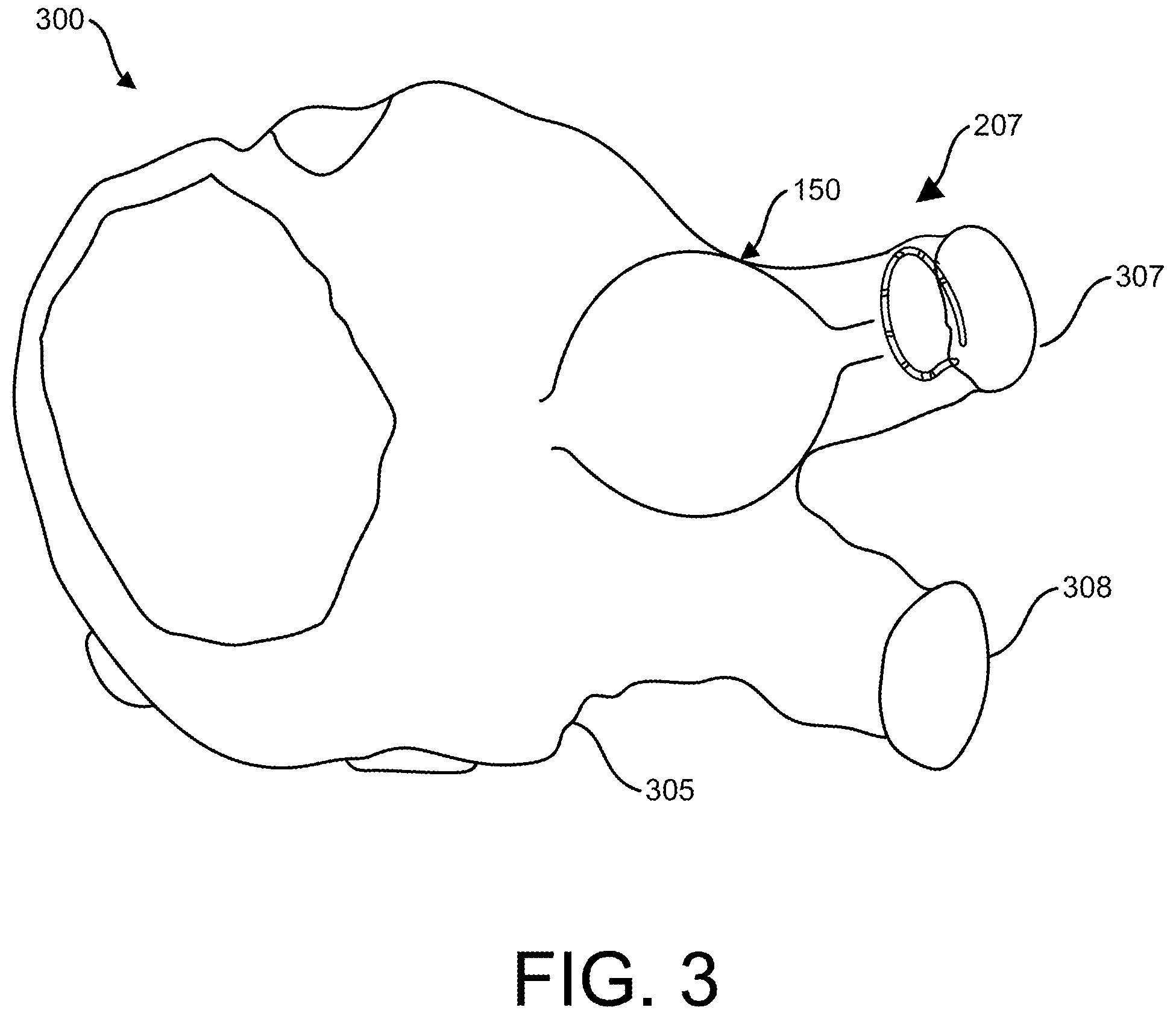 Patent US12167879 Figure 5 – Navigation-enabled cryoablation system with indirect device tracking