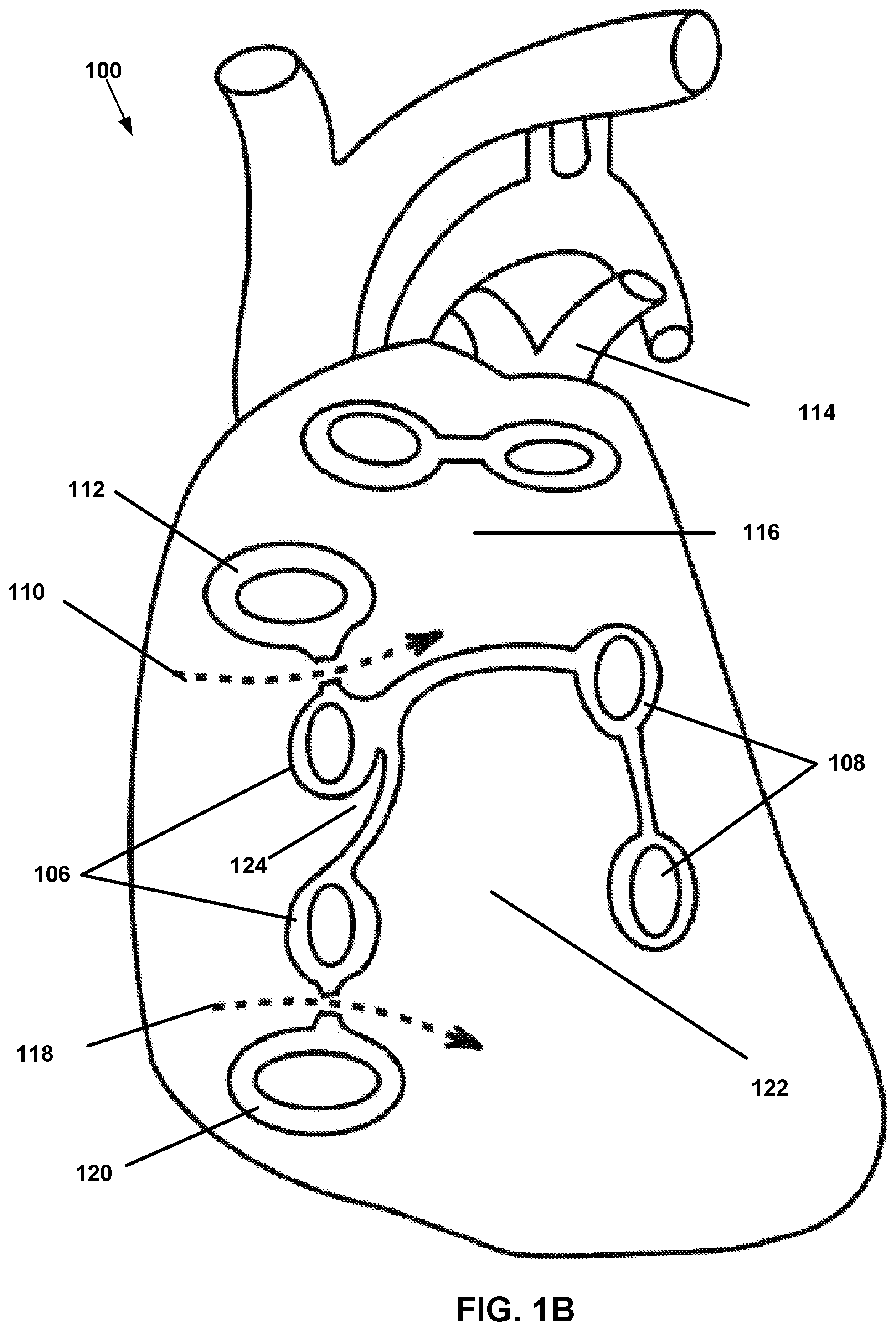 Patent US12167882 Figure 2 – Utilization of synergy EMR and EML to create a COXMAZE3 box lesion with radio frequency