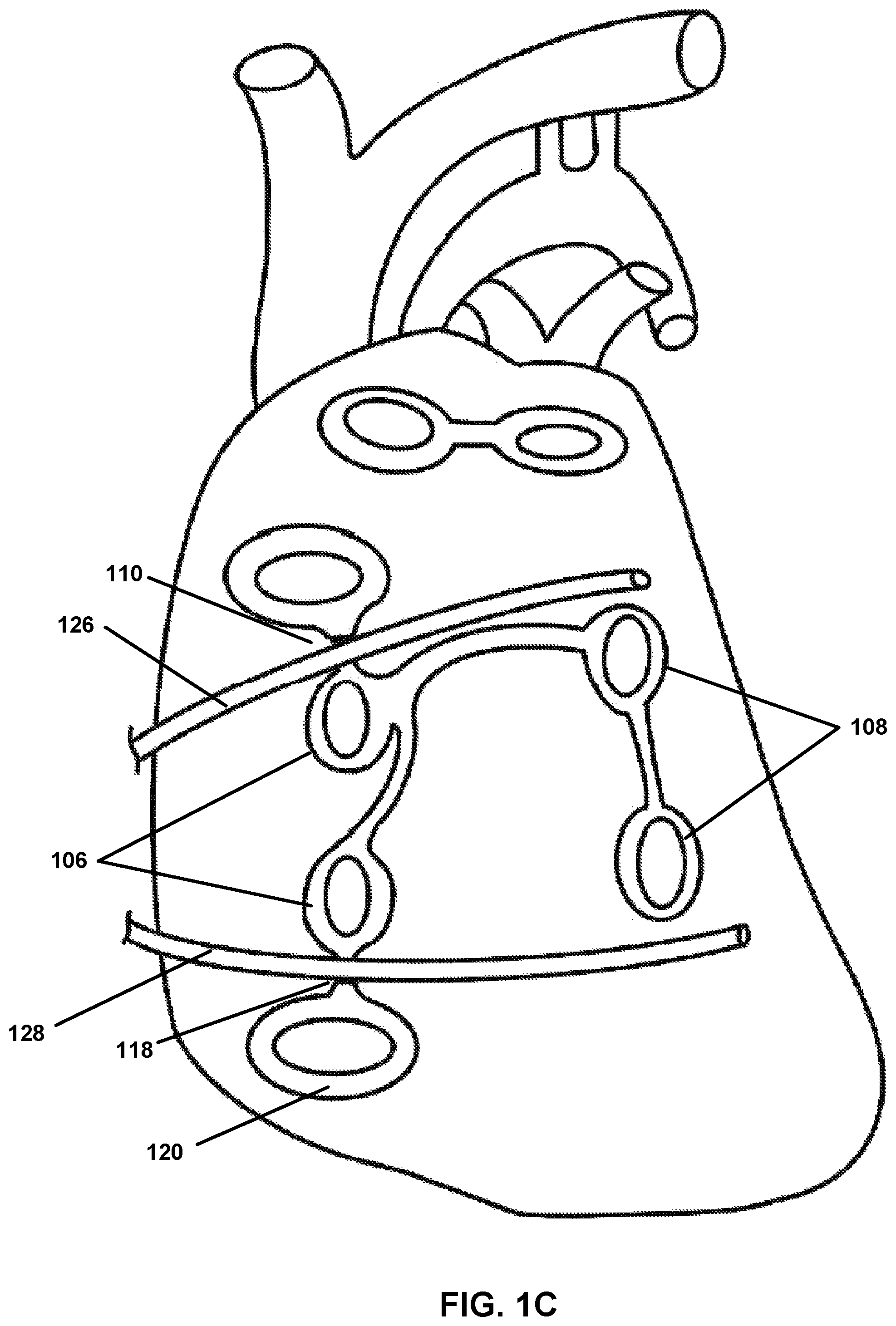 Patent US12167882 Figure 3 – Utilization of synergy EMR and EML to create a COXMAZE3 box lesion with radio frequency