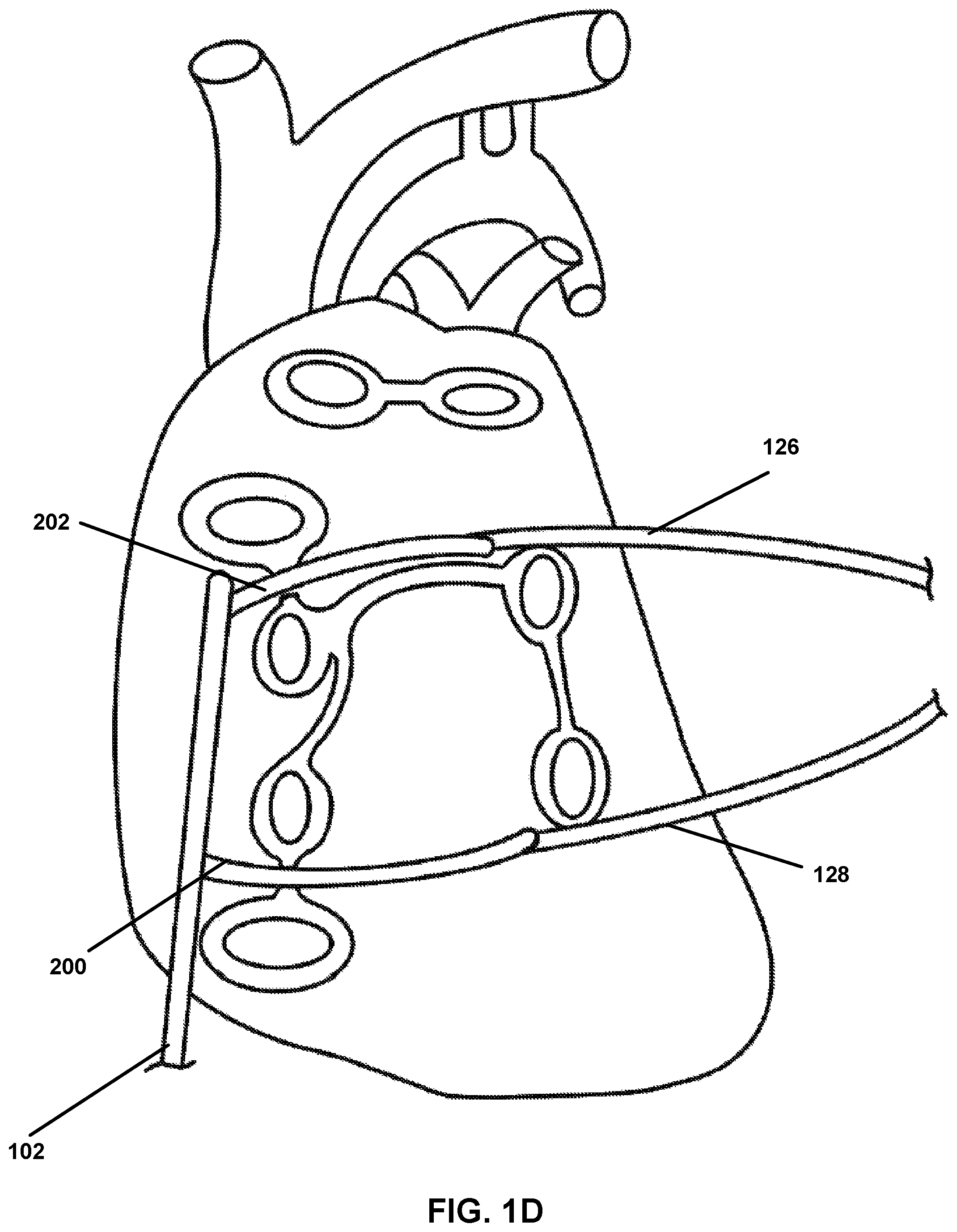 Patent US12167882 Figure 4 – Utilization of synergy EMR and EML to create a COXMAZE3 box lesion with radio frequency