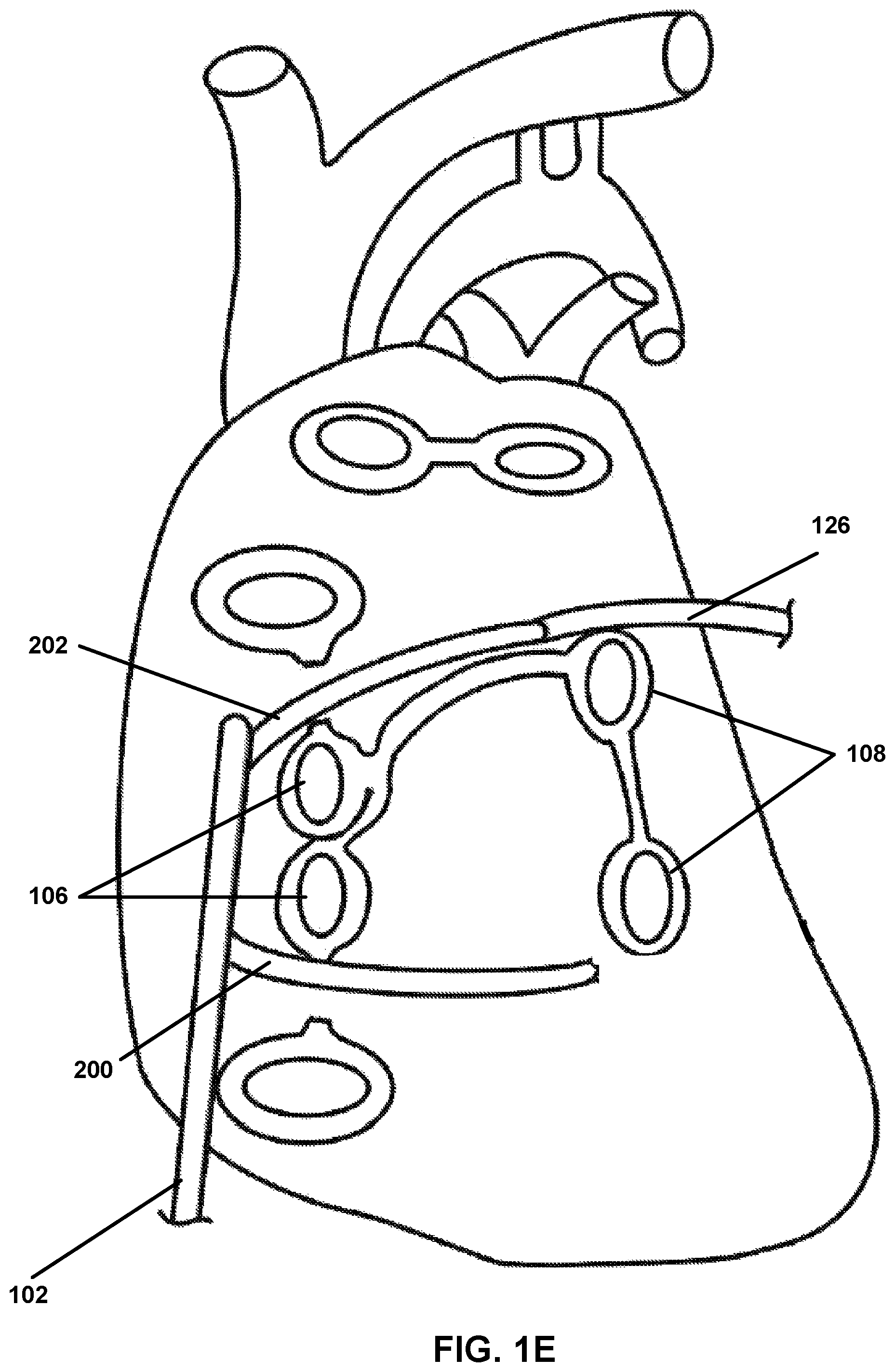 Patent US12167882 Figure 5 – Utilization of synergy EMR and EML to create a COXMAZE3 box lesion with radio frequency