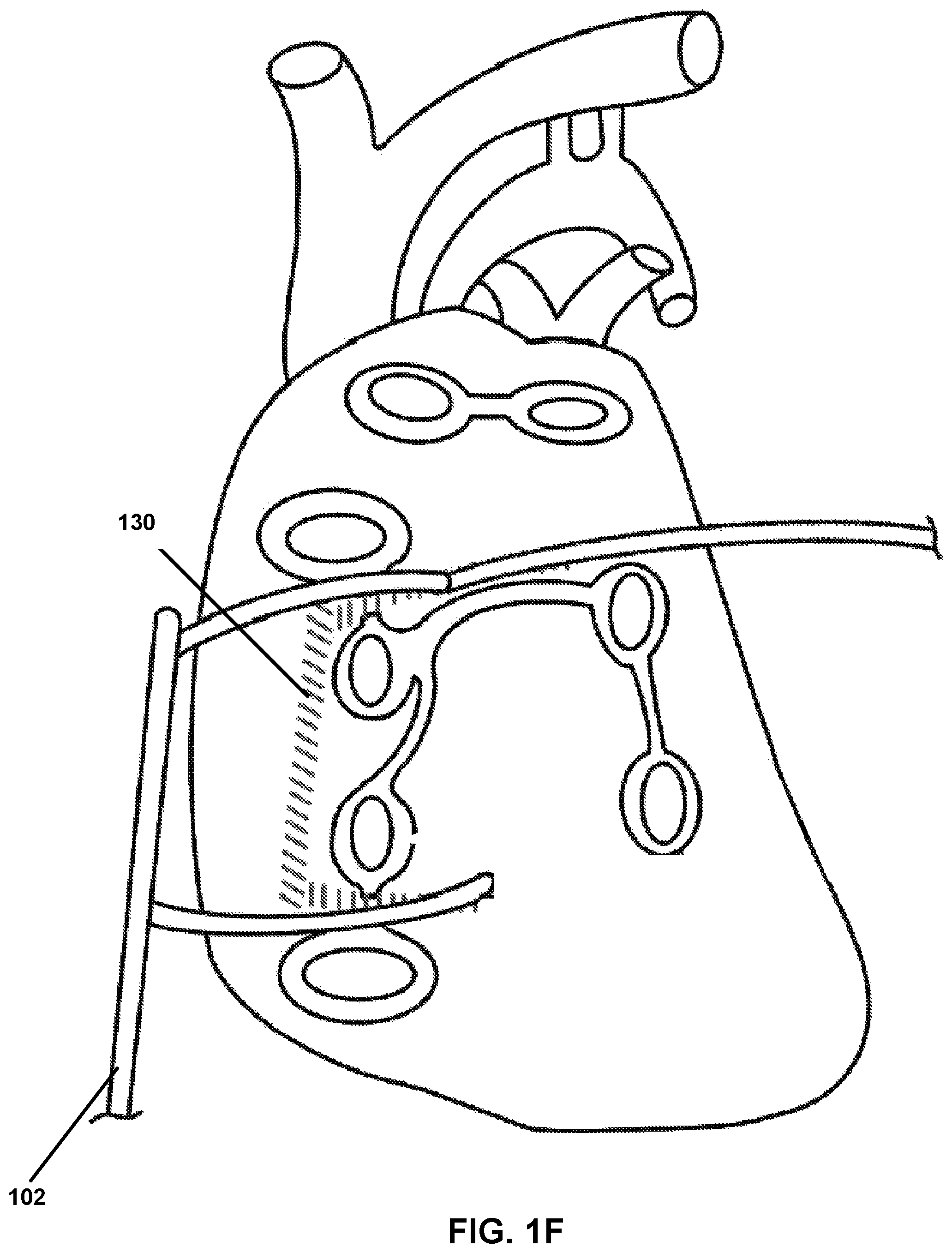 Patent US12167882 Figure 6 – Utilization of synergy EMR and EML to create a COXMAZE3 box lesion with radio frequency