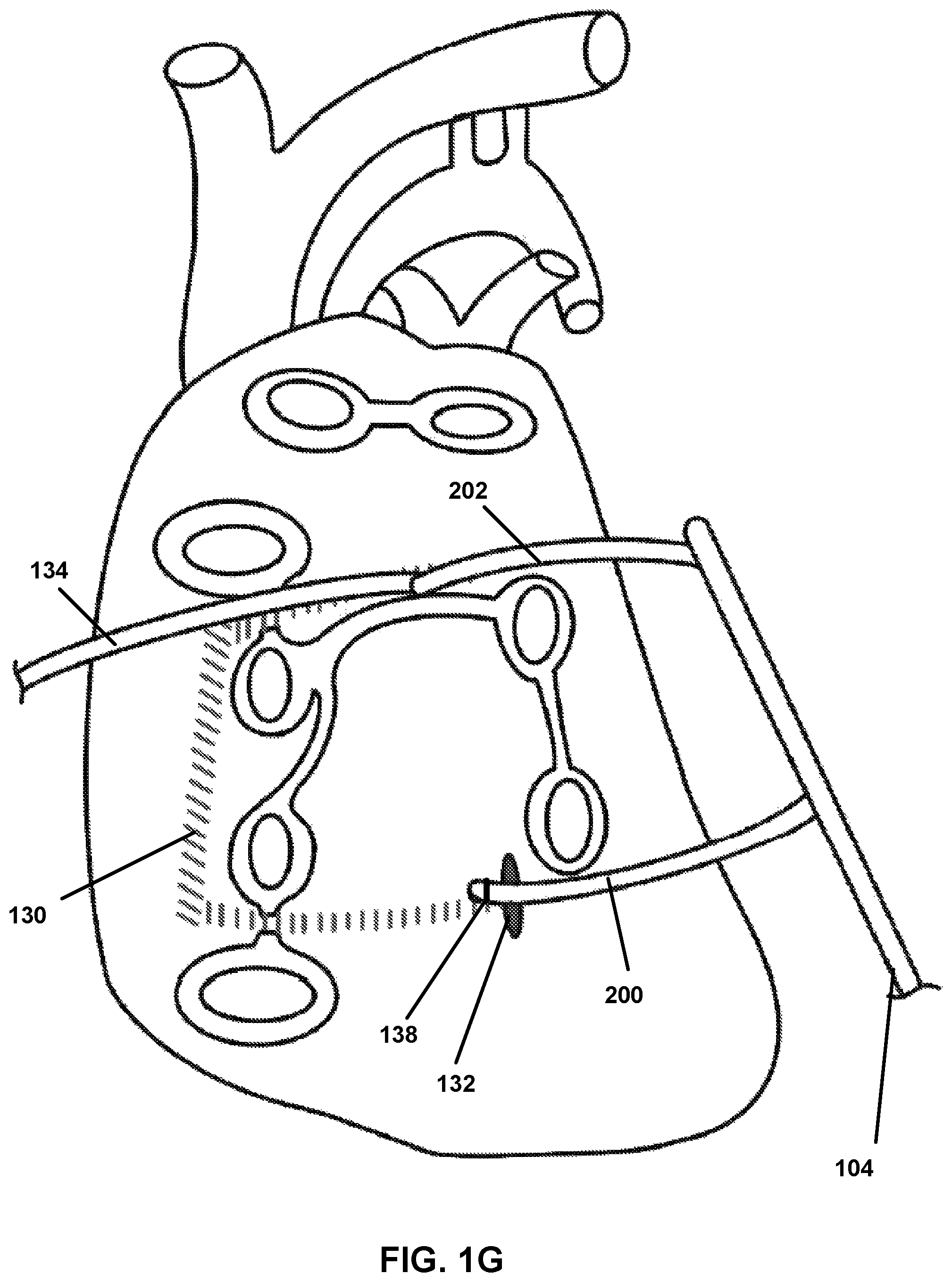 Patent US12167882 Figure 7 – Utilization of synergy EMR and EML to create a COXMAZE3 box lesion with radio frequency