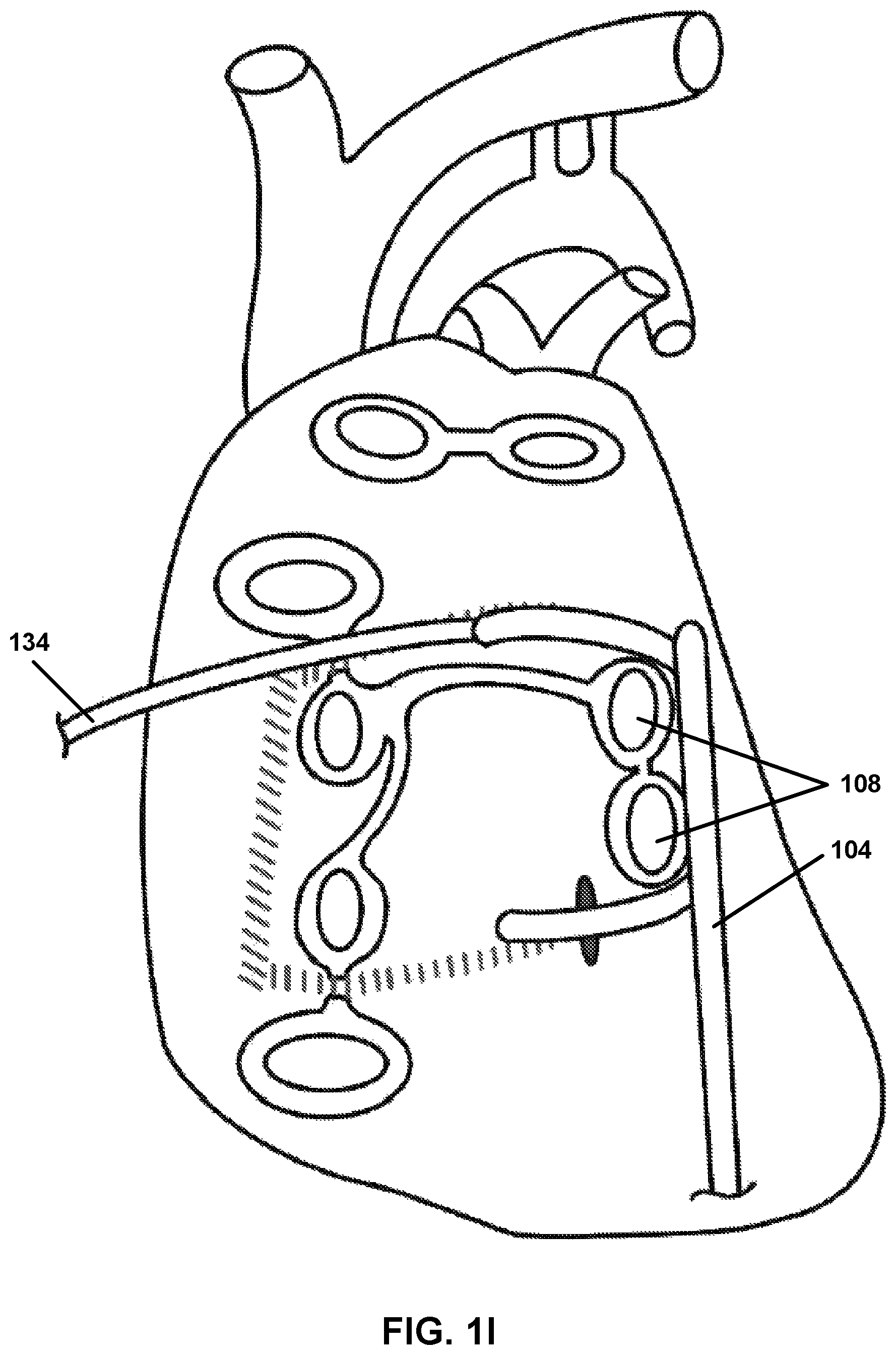 Patent US12167882 Figure 9 – Utilization of synergy EMR and EML to create a COXMAZE3 box lesion with radio frequency