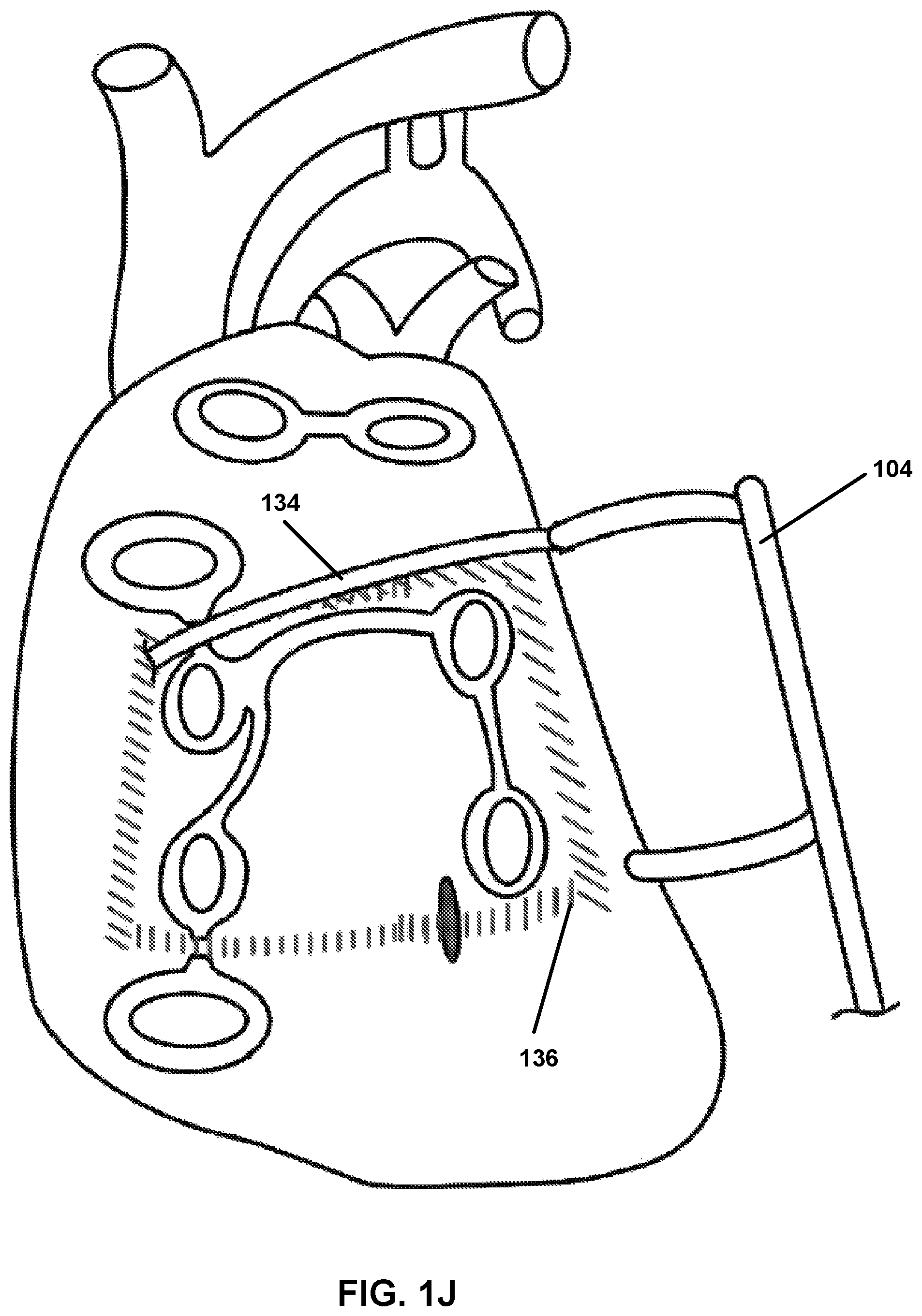 Patent US12167882 Figure 10 – Utilization of synergy EMR and EML to create a COXMAZE3 box lesion with radio frequency