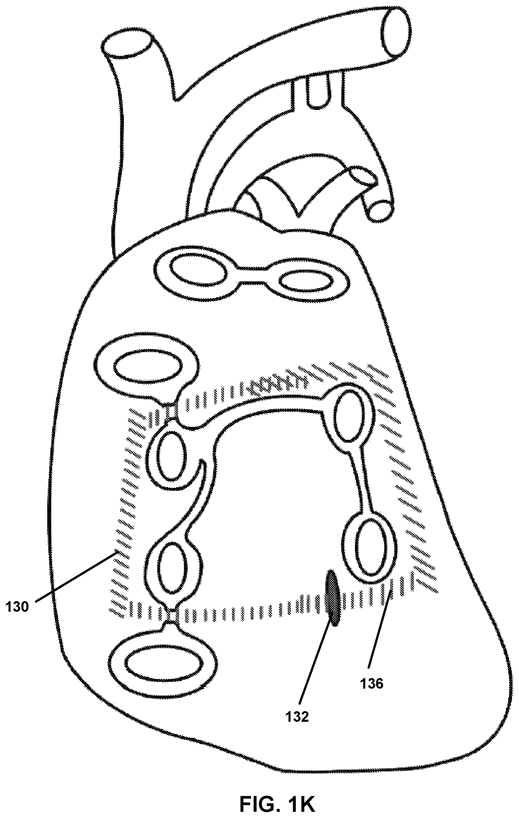 Patent US12167882 Figure 11 – Utilization of synergy EMR and EML to create a COXMAZE3 box lesion with radio frequency