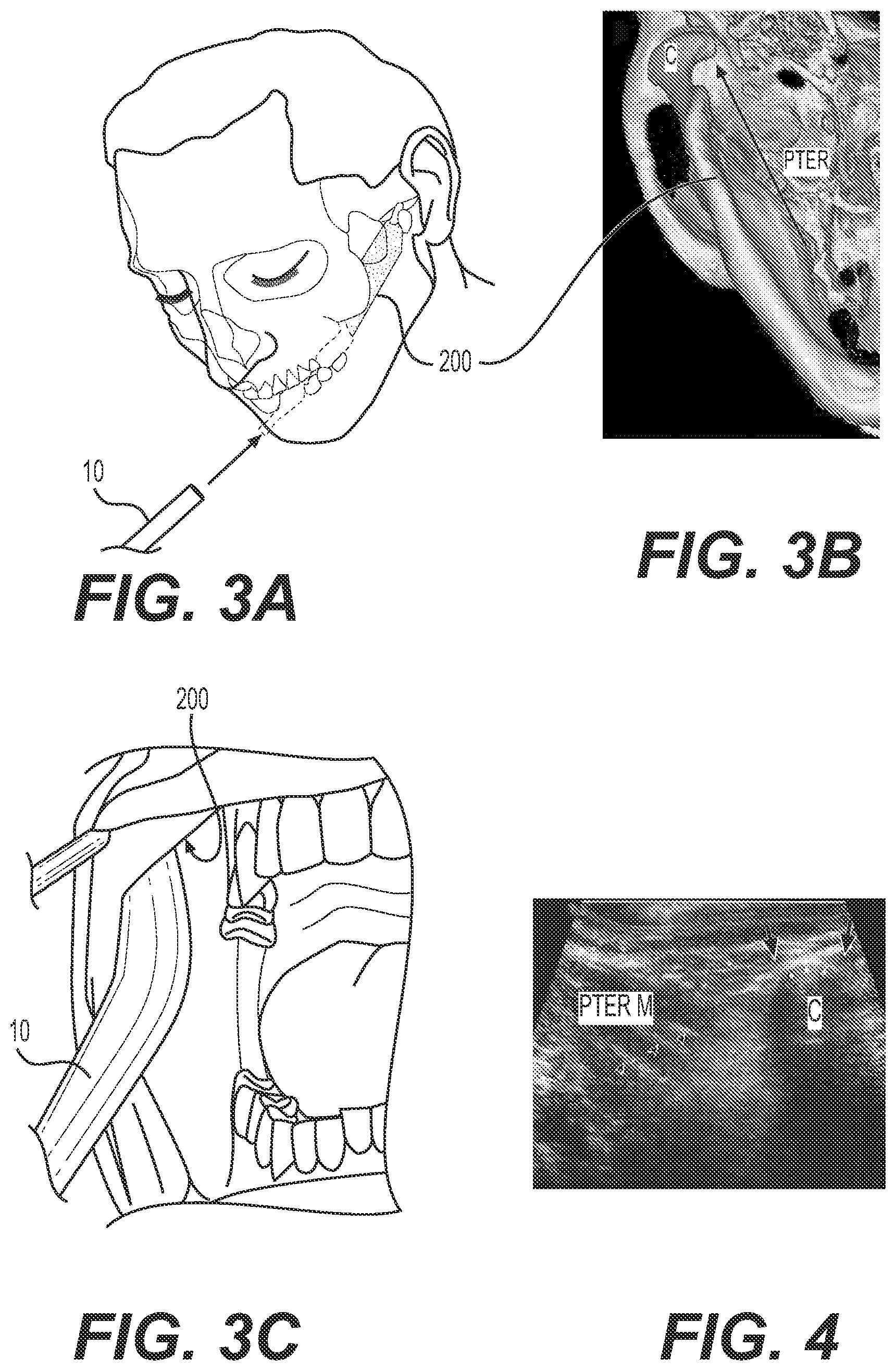 Patent US12167887 Figure 2 – Transoral ultrasound probe