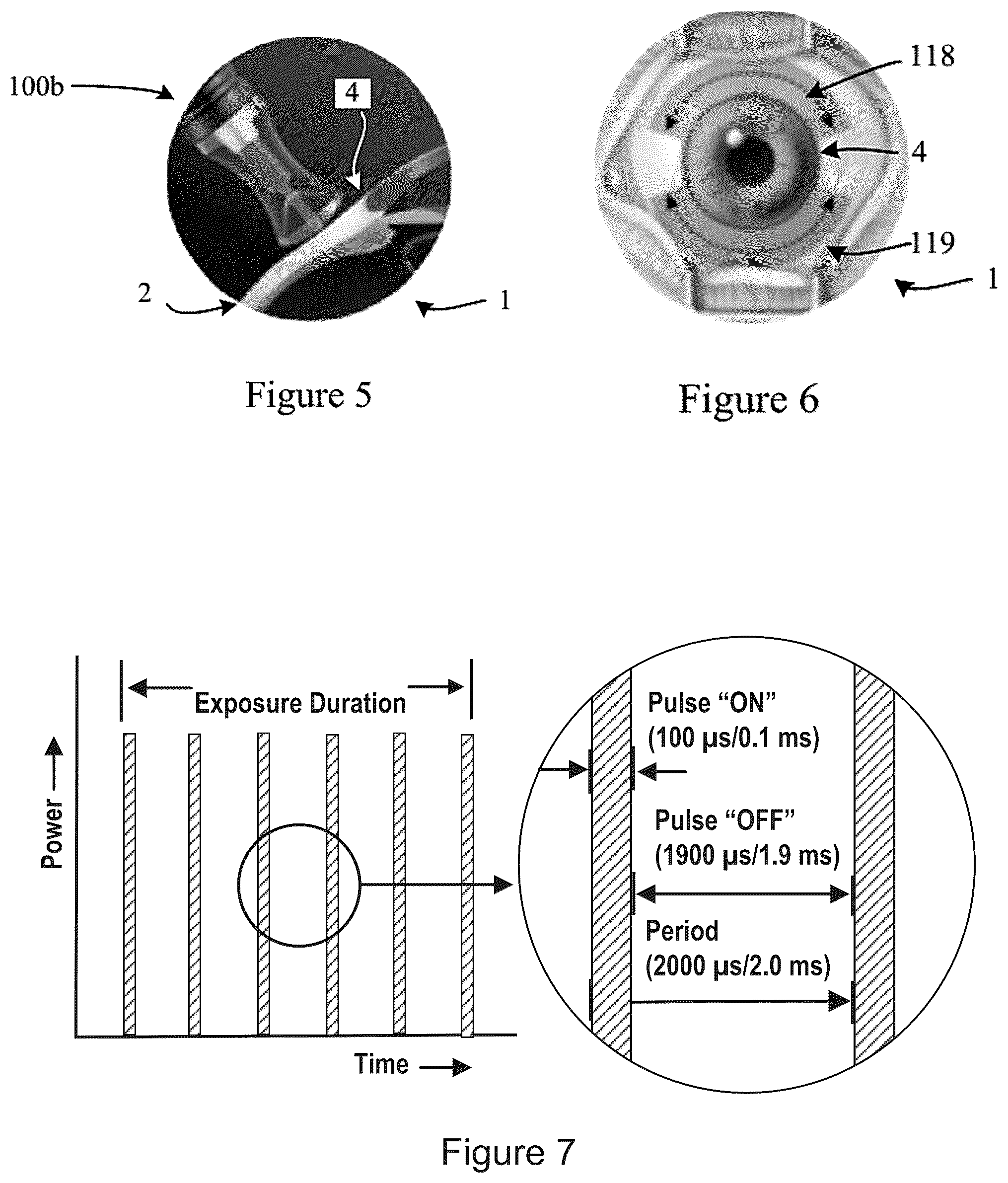 Patent US12167891 Figure 3 – Handheld ophthalmic laser system with replaceable contact tips and treatment guide