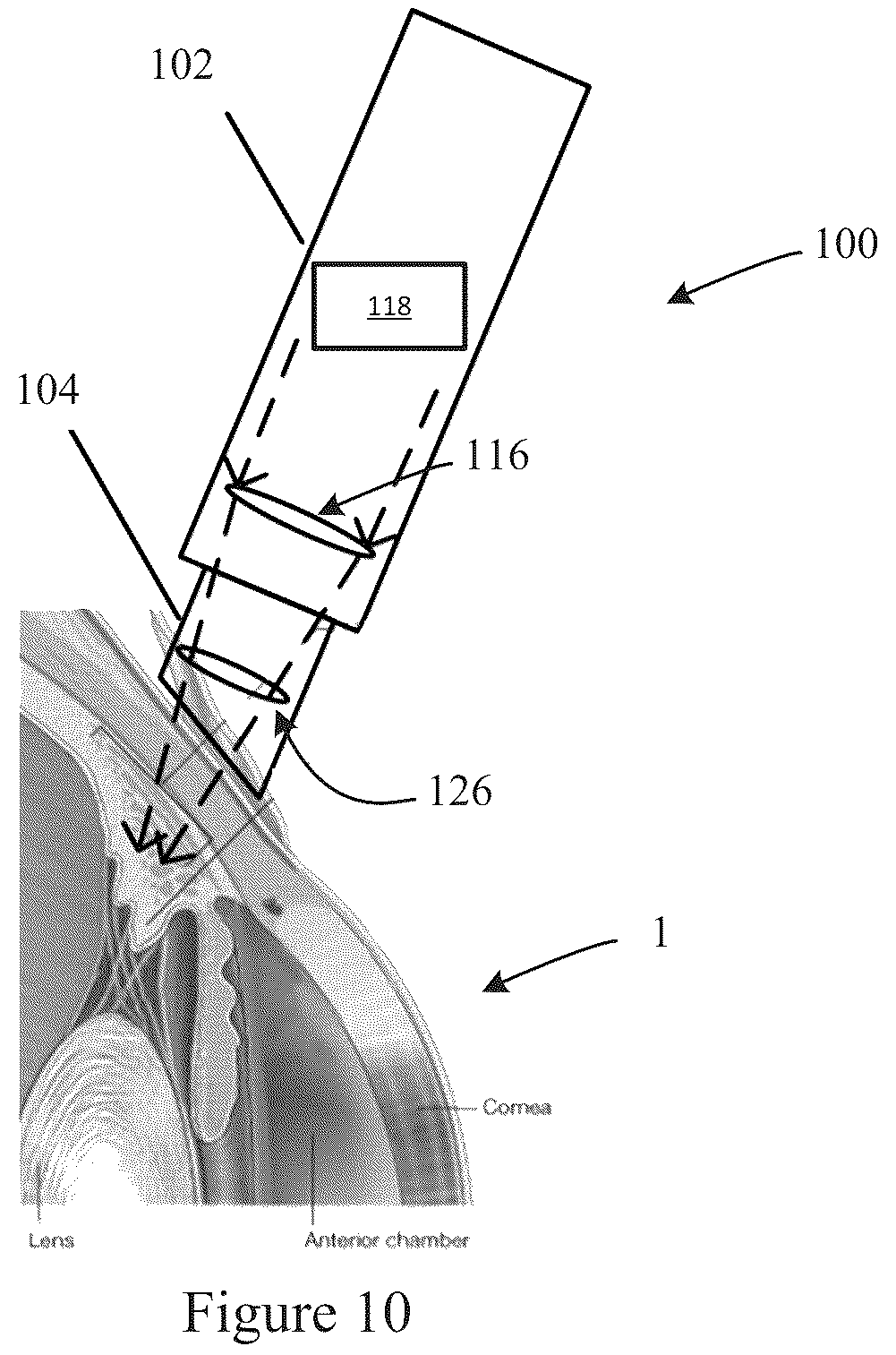 Patent US12167891 Figure 5 – Handheld ophthalmic laser system with replaceable contact tips and treatment guide