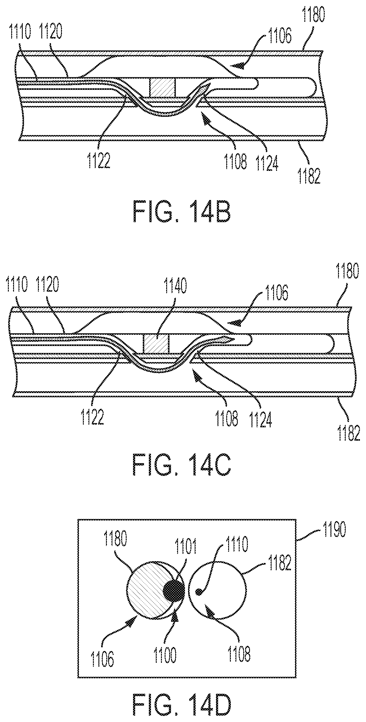 Patent US12167896 Figure 11 – Systems, methods, and catheters for endovascular treatment of a blood vessel