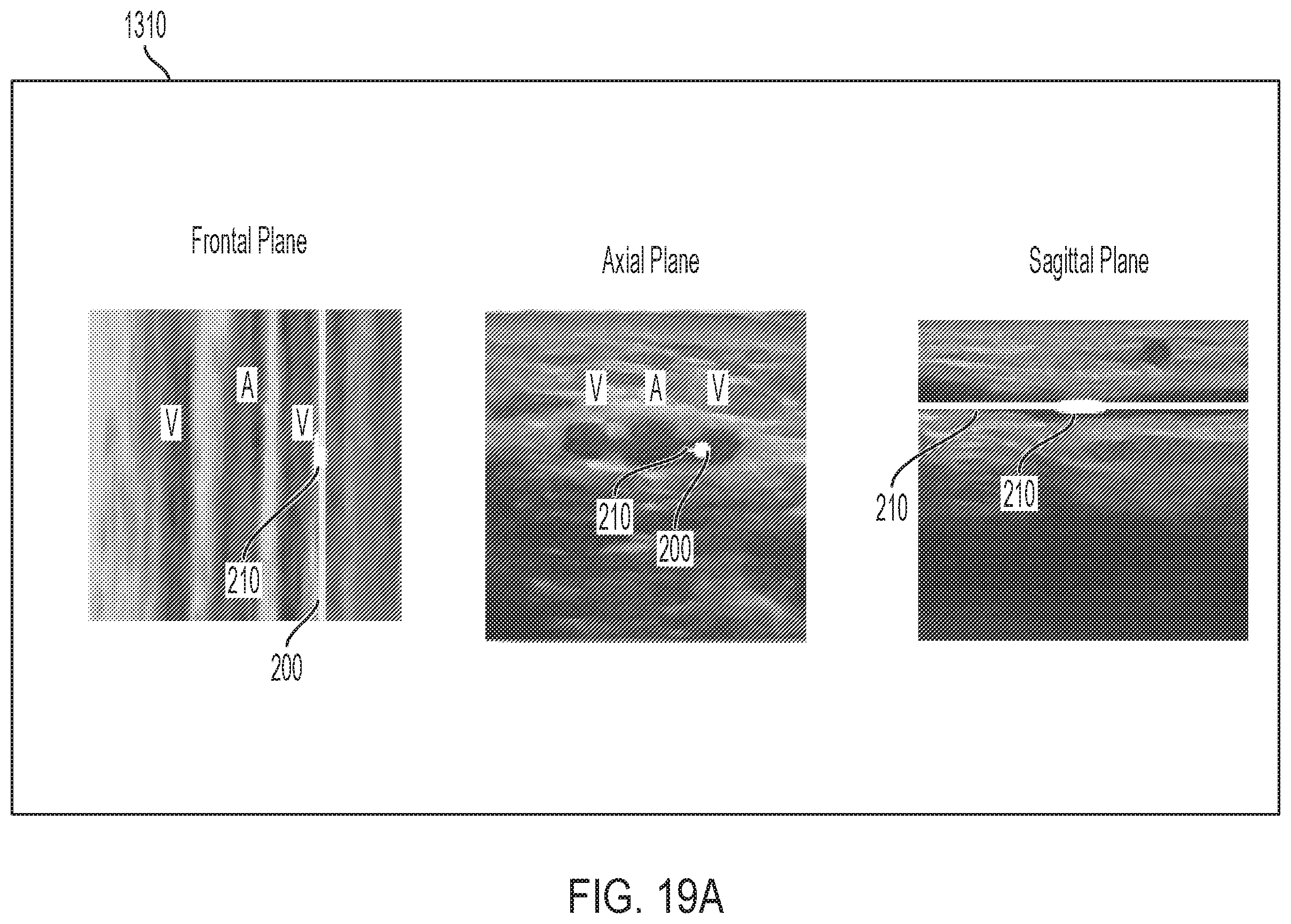 Patent US12167896 Figure 17 – Systems, methods, and catheters for endovascular treatment of a blood vessel