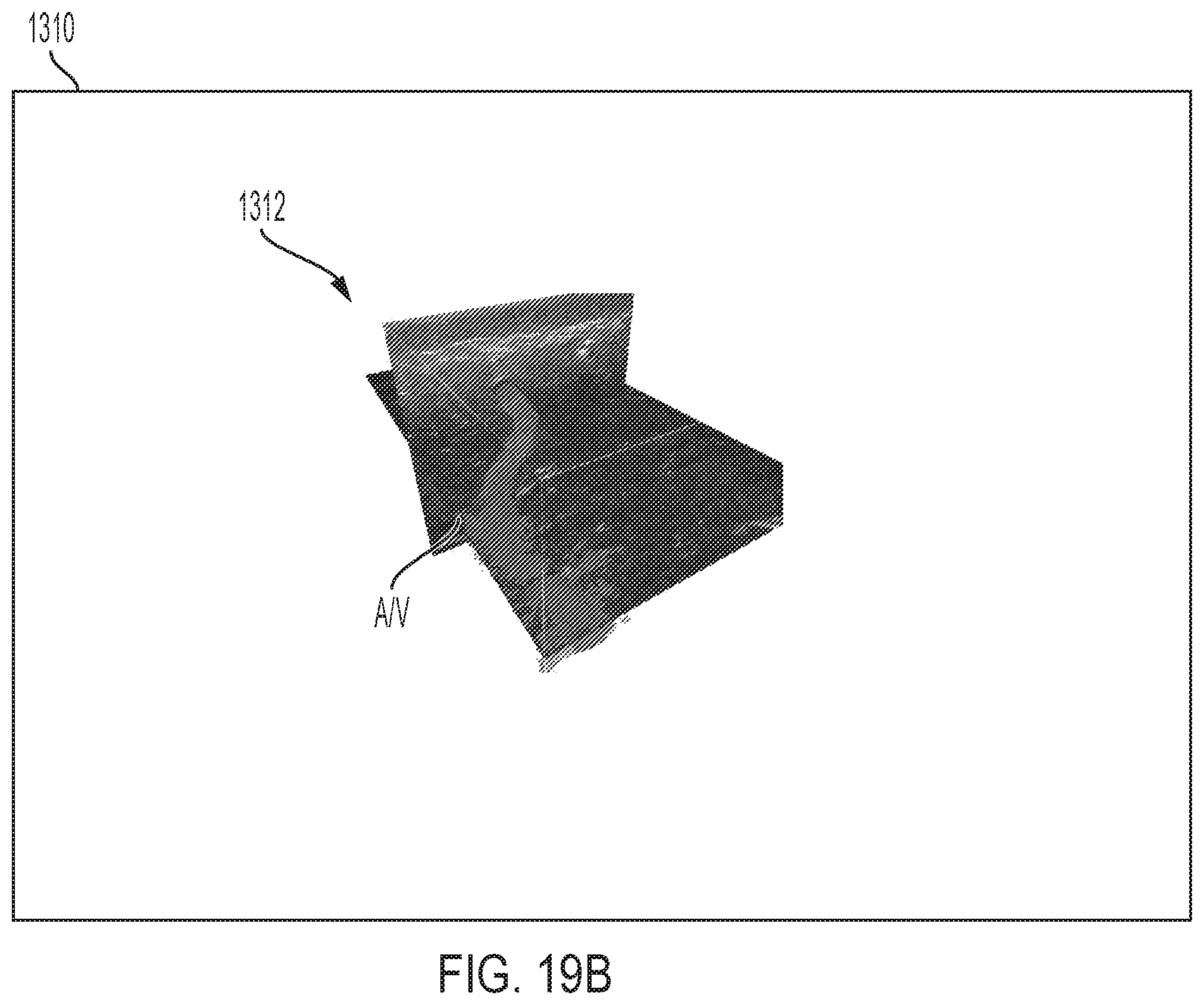 Patent US12167896 Figure 18 – Systems, methods, and catheters for endovascular treatment of a blood vessel