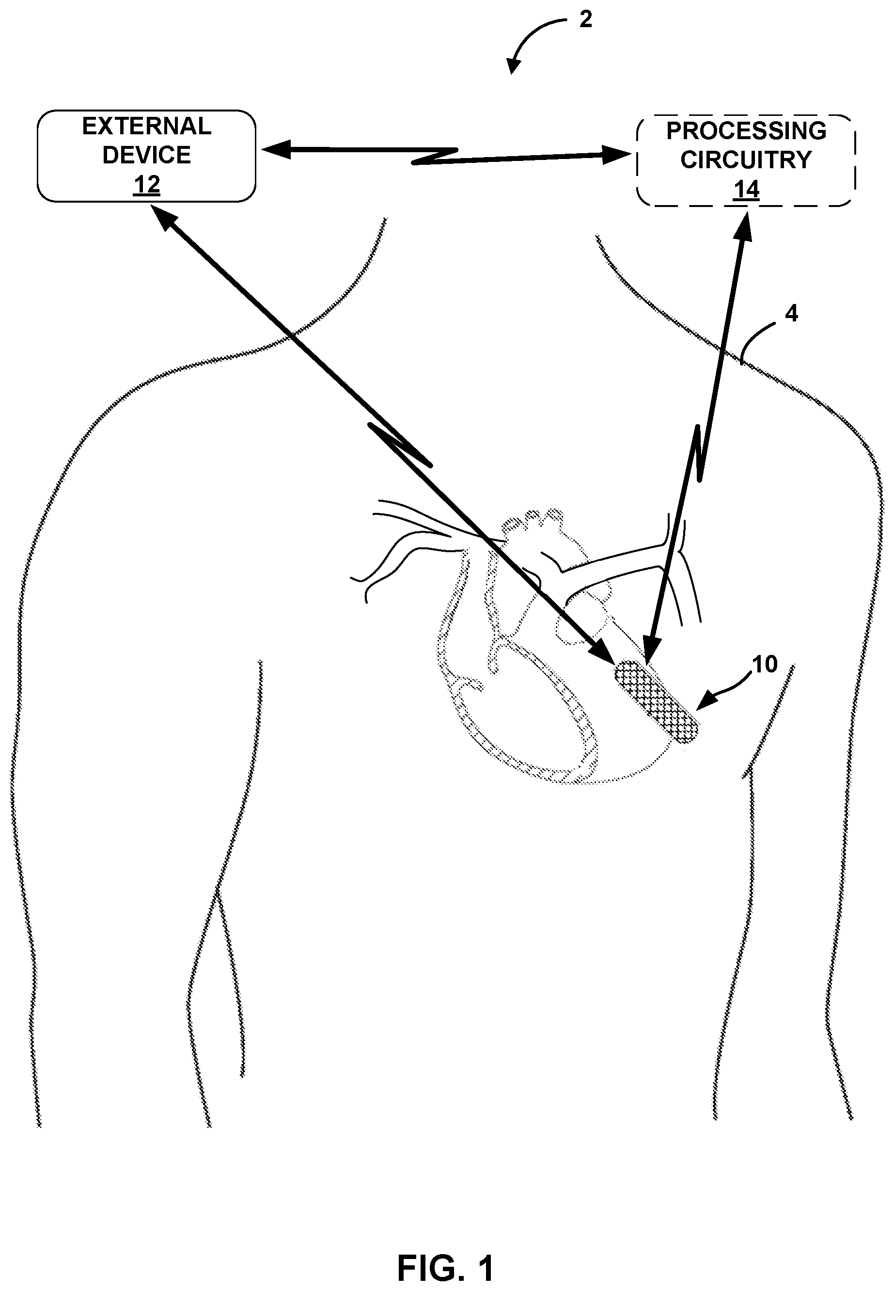 Patent US12167908 Figure 1 – Dynamic bio impedance range adjustment for a medical device