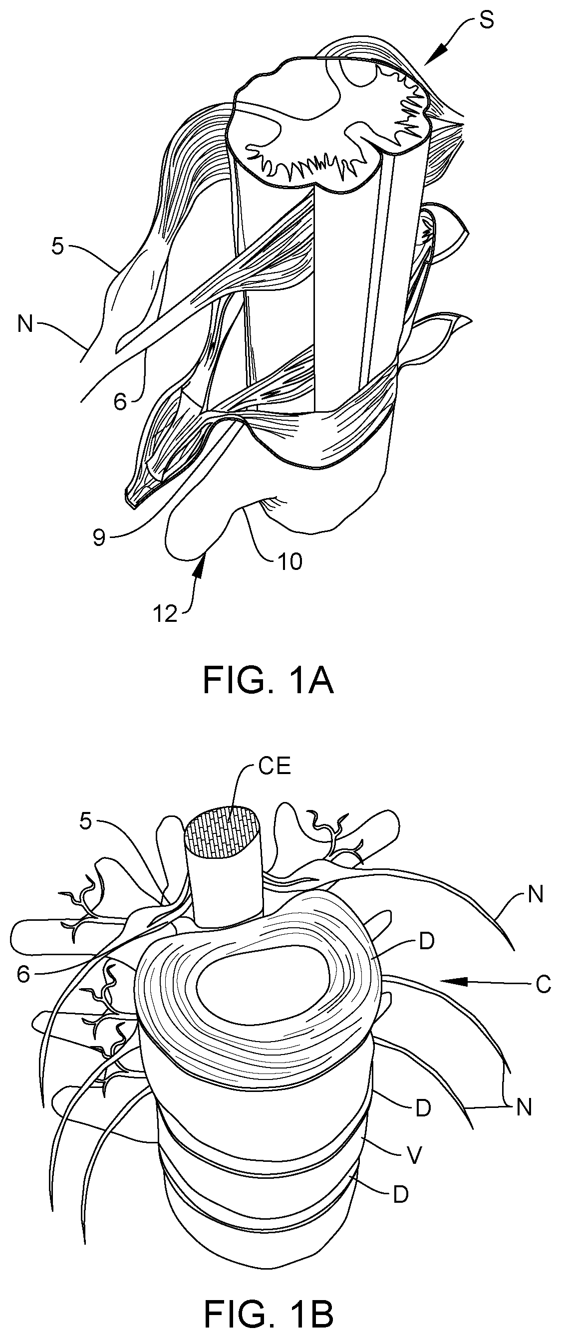 Patent US12167915 Figure 1 – Bipolar nerve stimulation/monitoring cuff