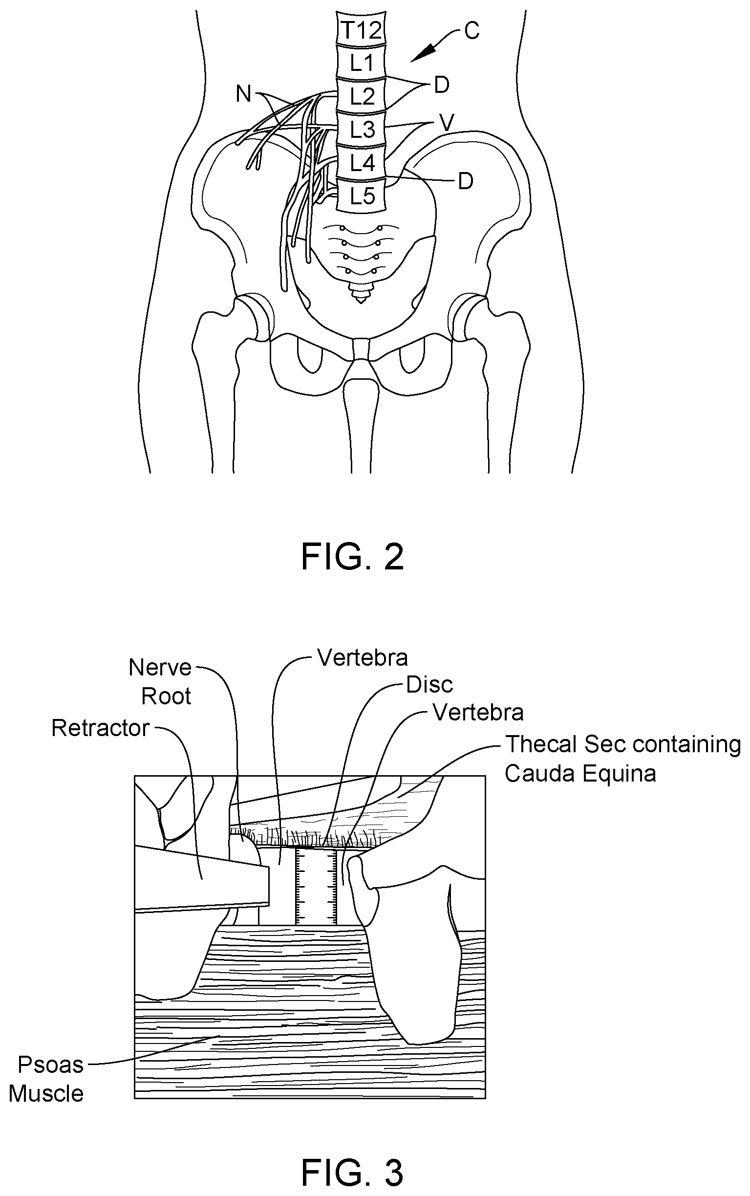 Patent US12167915 Figure 2 – Bipolar nerve stimulation/monitoring cuff