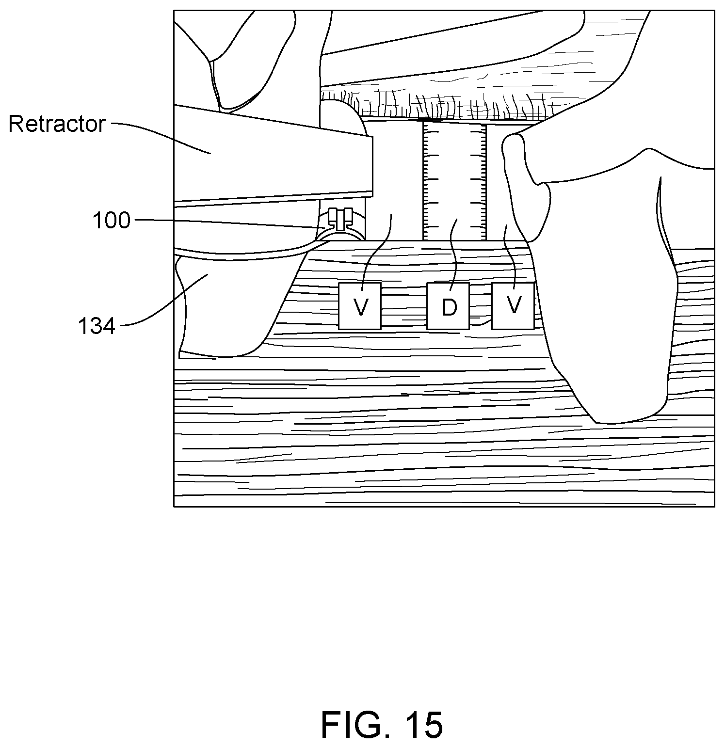 Patent US12167915 Figure 11 – Bipolar nerve stimulation/monitoring cuff