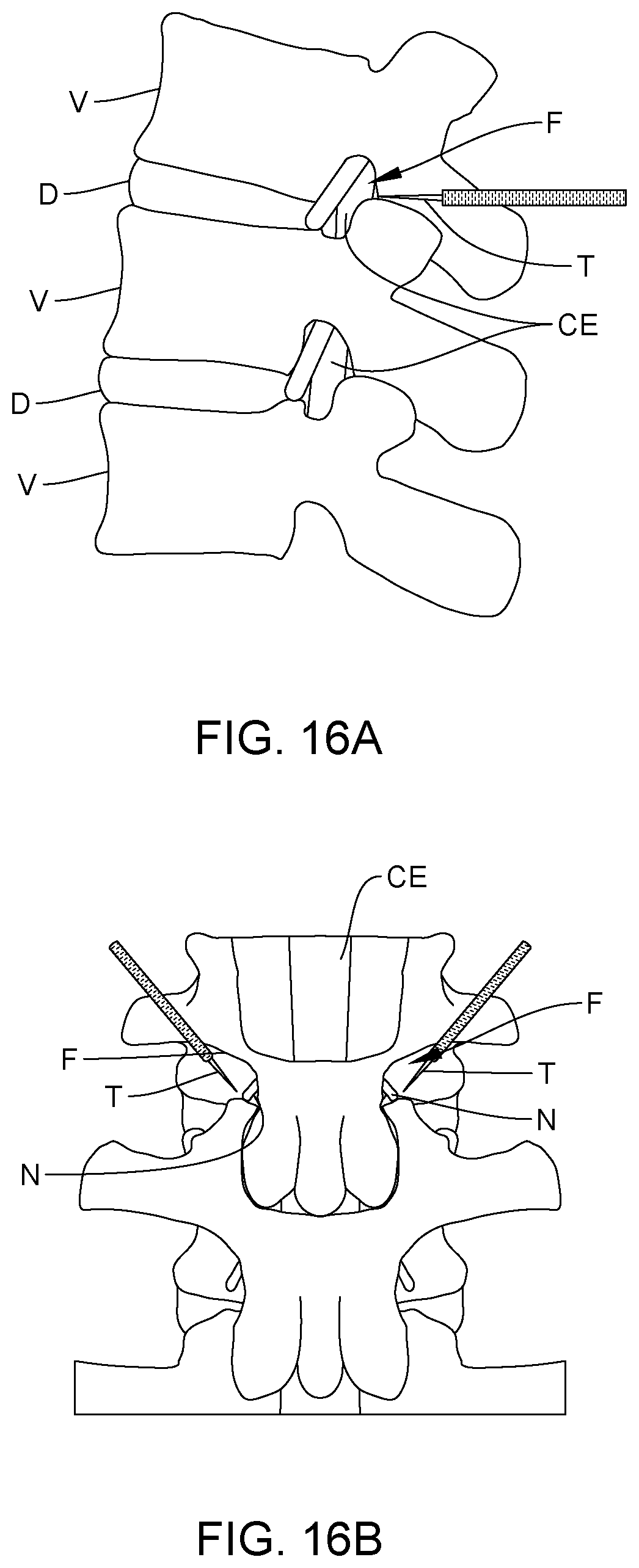 Patent US12167915 Figure 12 – Bipolar nerve stimulation/monitoring cuff