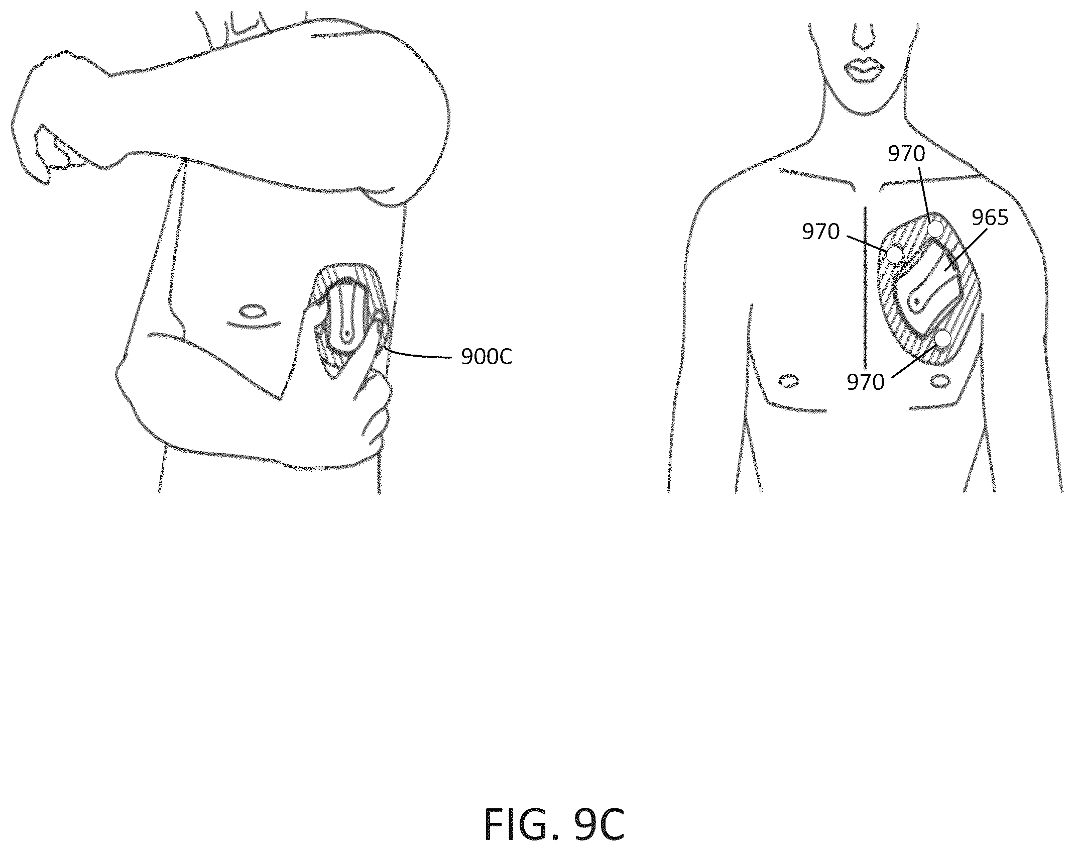 Patent US12167916 Figure 17 – Ambulatory medical device including a digital front-end