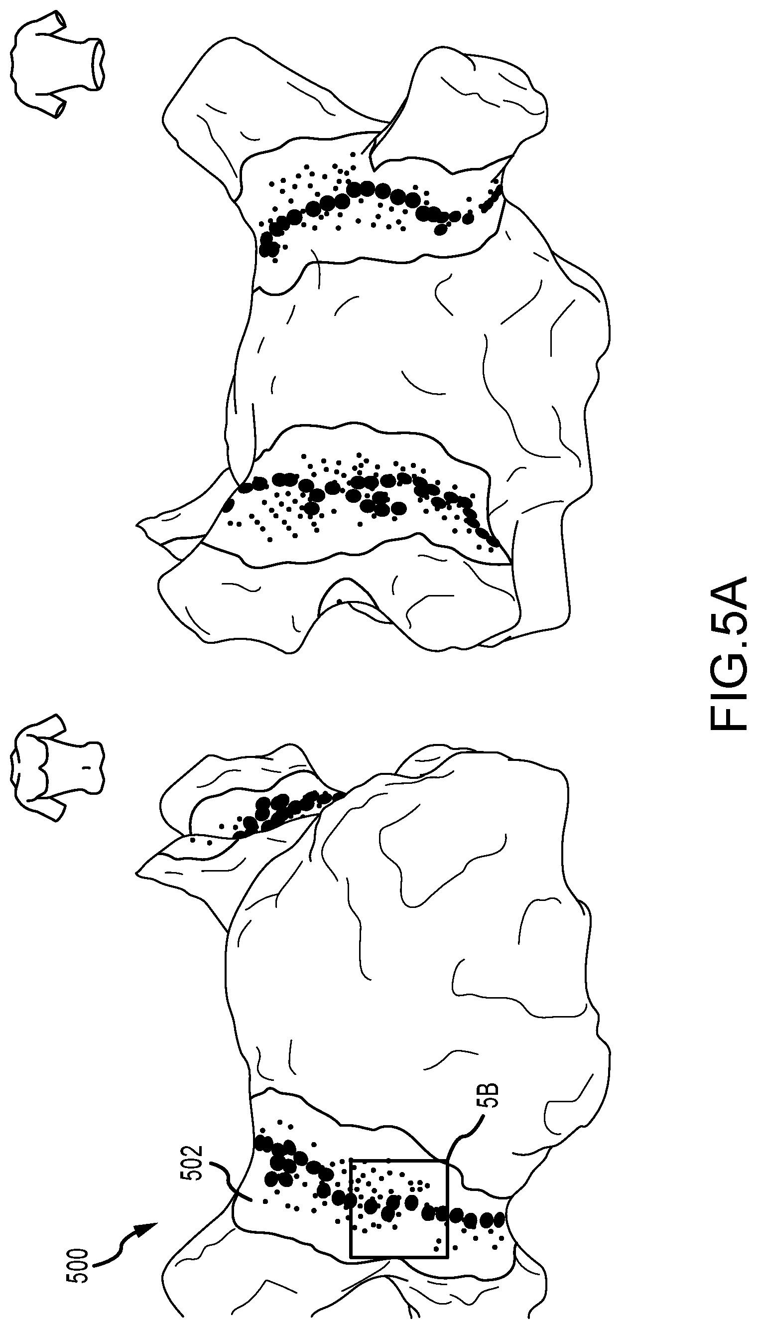 Patent US12167917 Figure 5 – System and method for detection and mapping of near field conduction in scar tissue