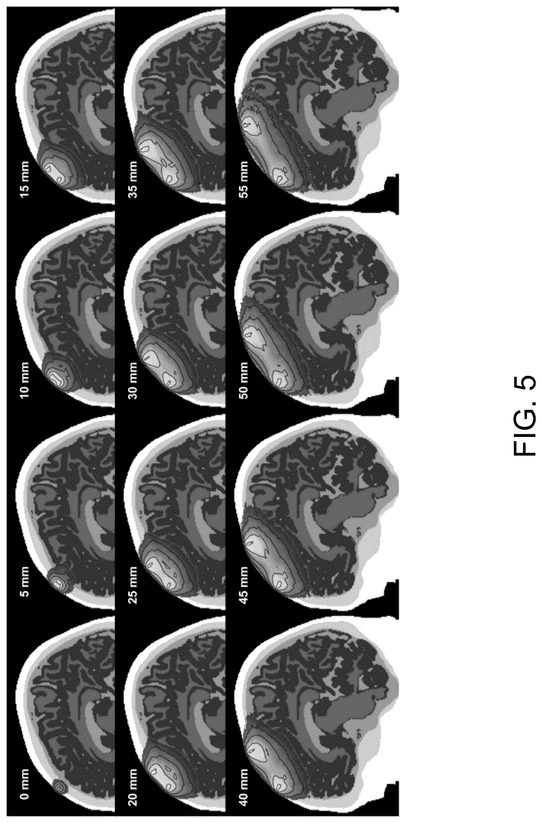Patent US12167919 Figure 5 – System and method for non-invasive, intracranial brain motion monitoring