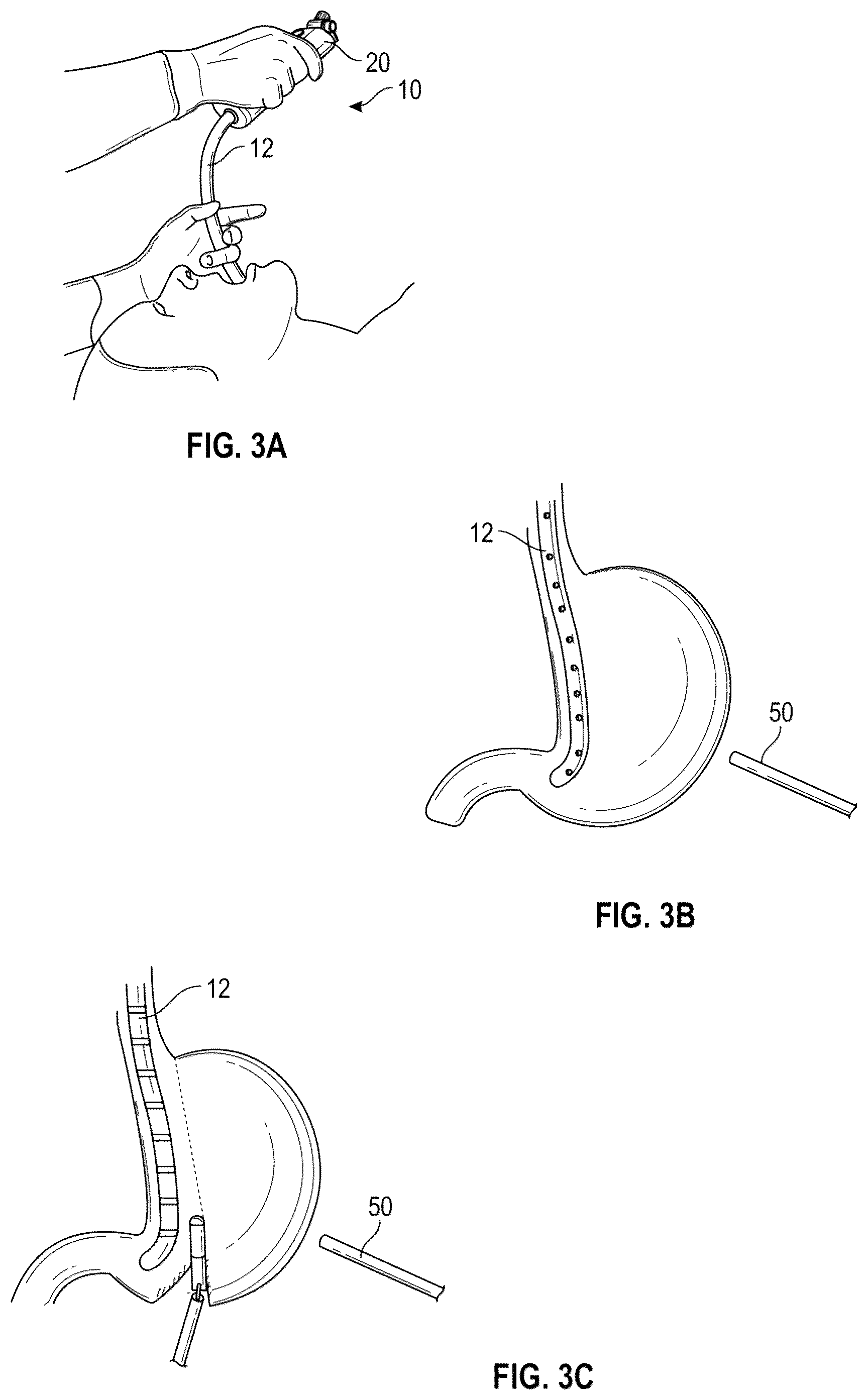 Patent US12167939 Figure 3 – Surgical devices and methods for bariatric and gastroesophageal surgery