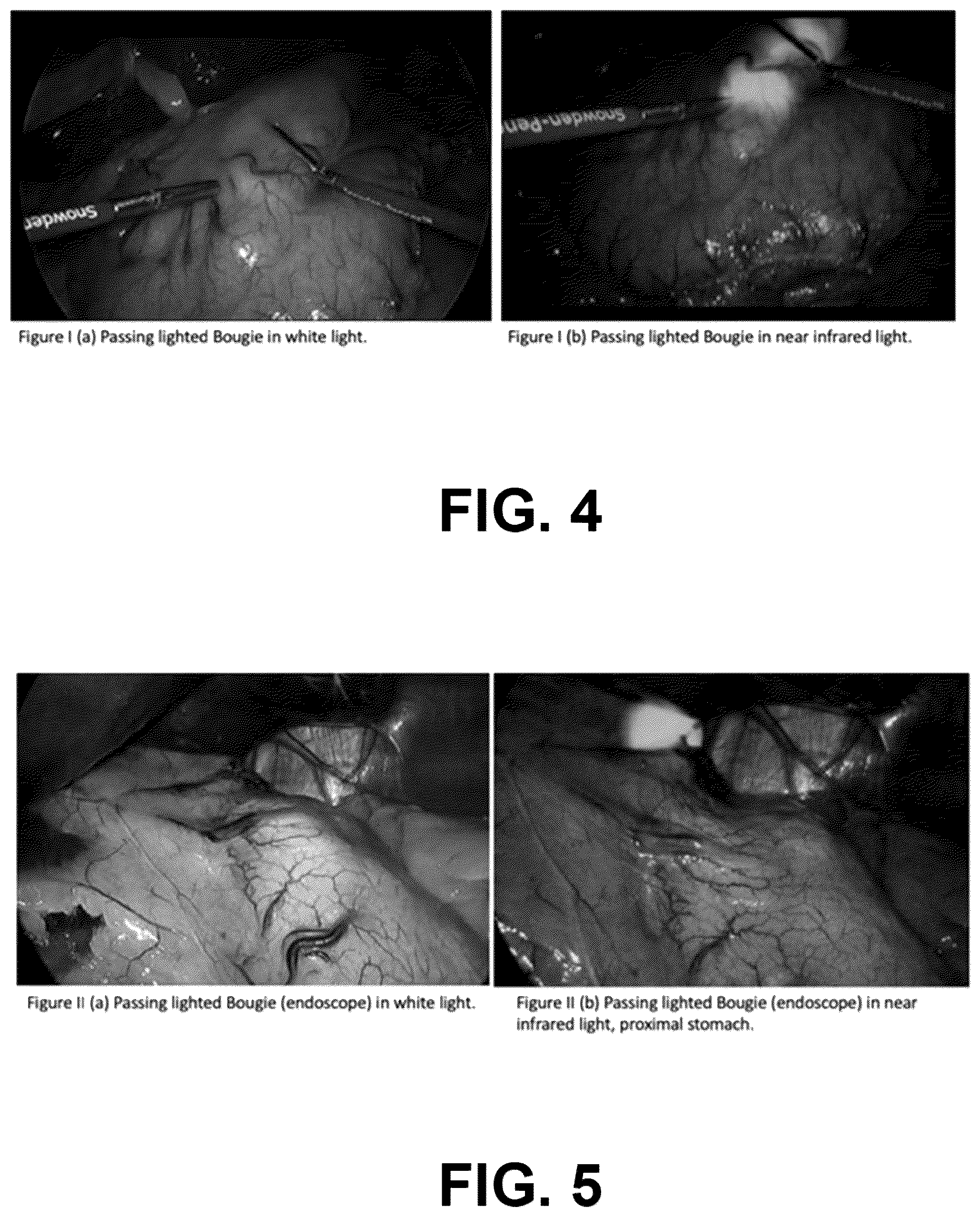 Patent US12167939 Figure 4 – Surgical devices and methods for bariatric and gastroesophageal surgery