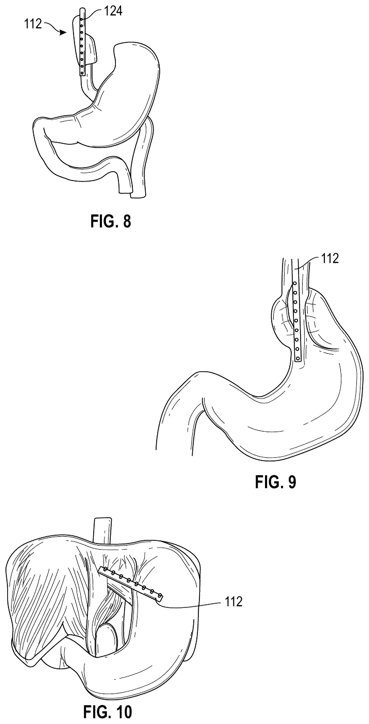 Patent US12167939 Figure 7 – Surgical devices and methods for bariatric and gastroesophageal surgery