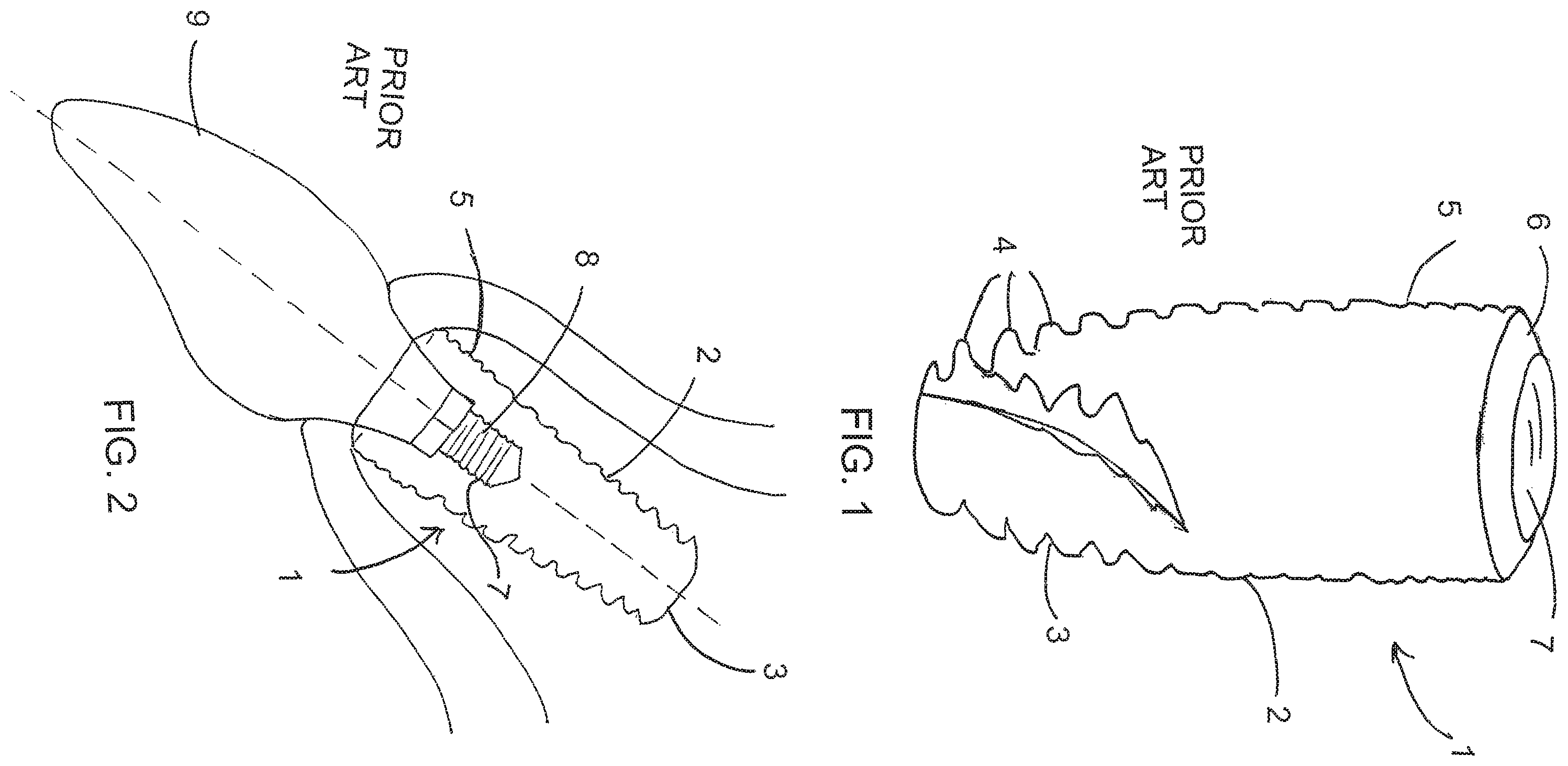 Patent US12167950 Figure 1 – Dental implant