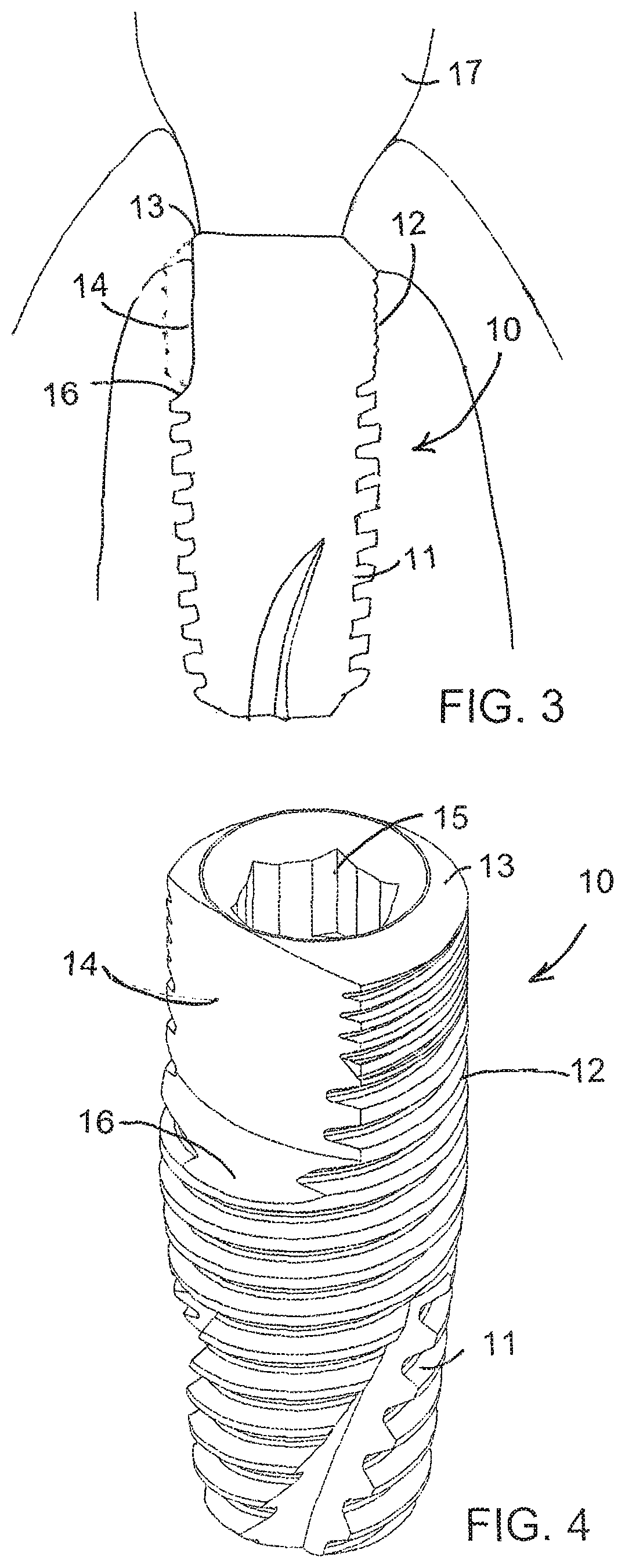 Patent US12167950 Figure 2 – Dental implant