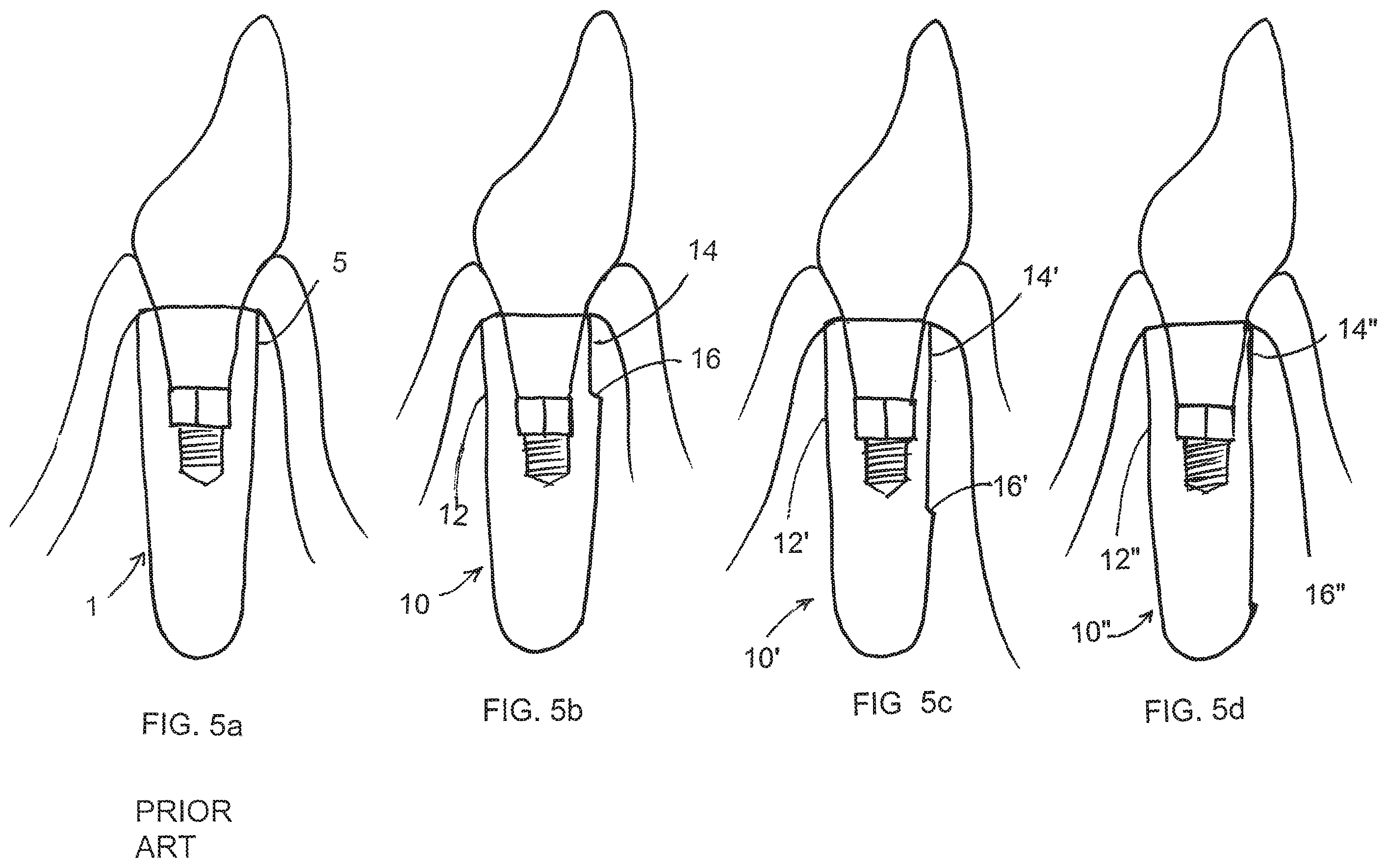 Patent US12167950 Figure 3 – Dental implant
